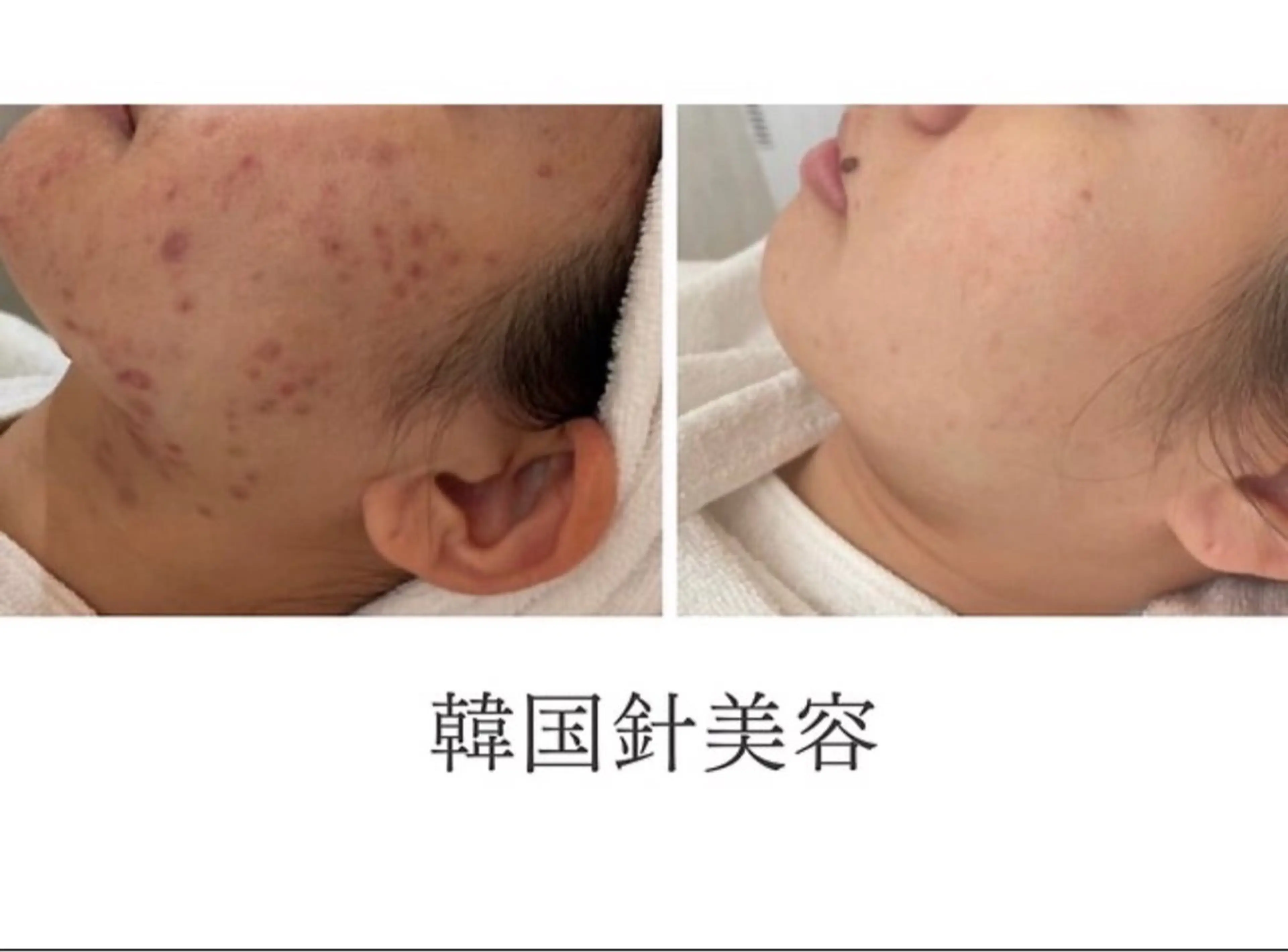 エステ 医療提携/ニキビ毛穴 サロンドエクラ南堀江のエステ・リラクイメージ