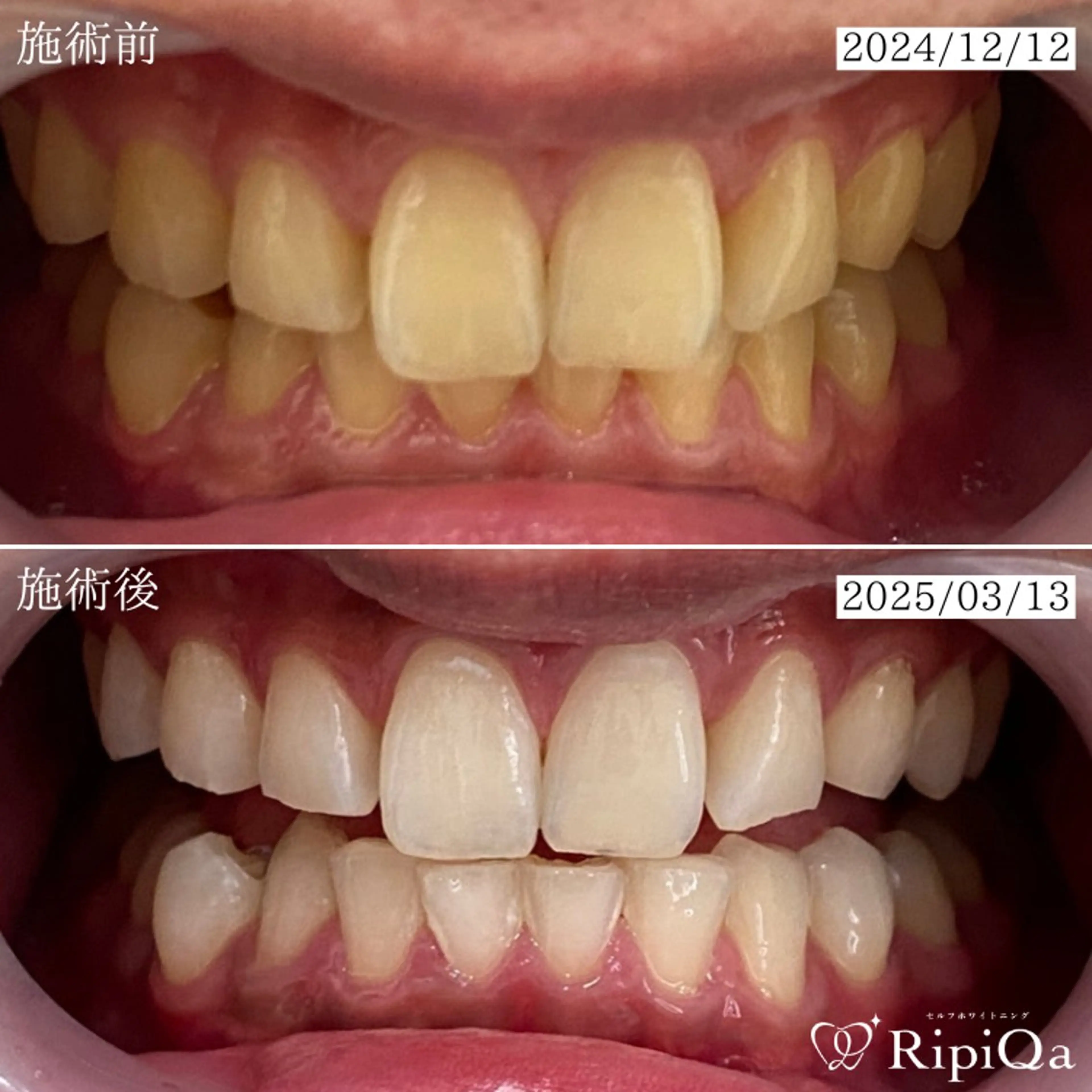 セルフホワイトニング RipiQaのその他イメージ