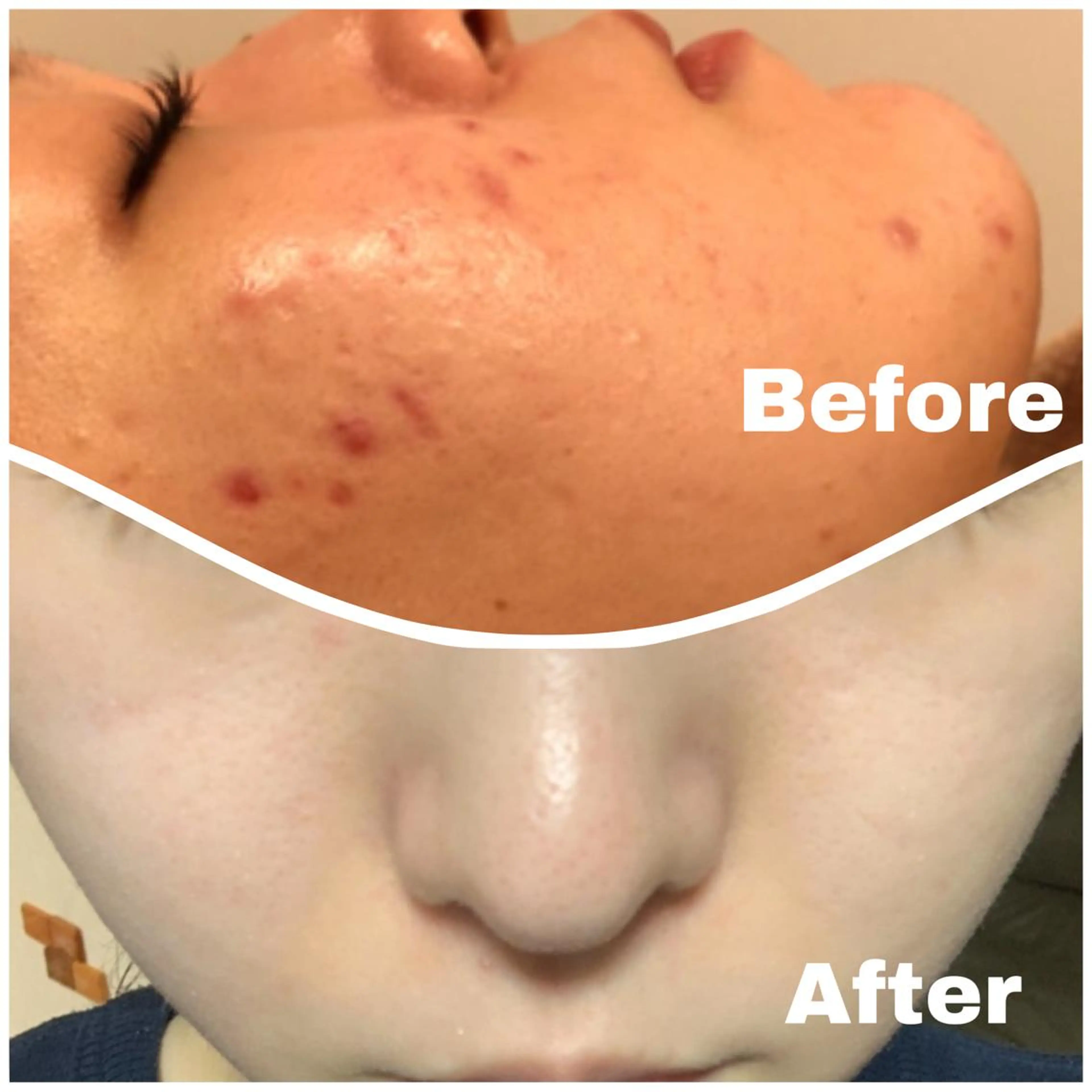 肌質改善 併用で半額の写真