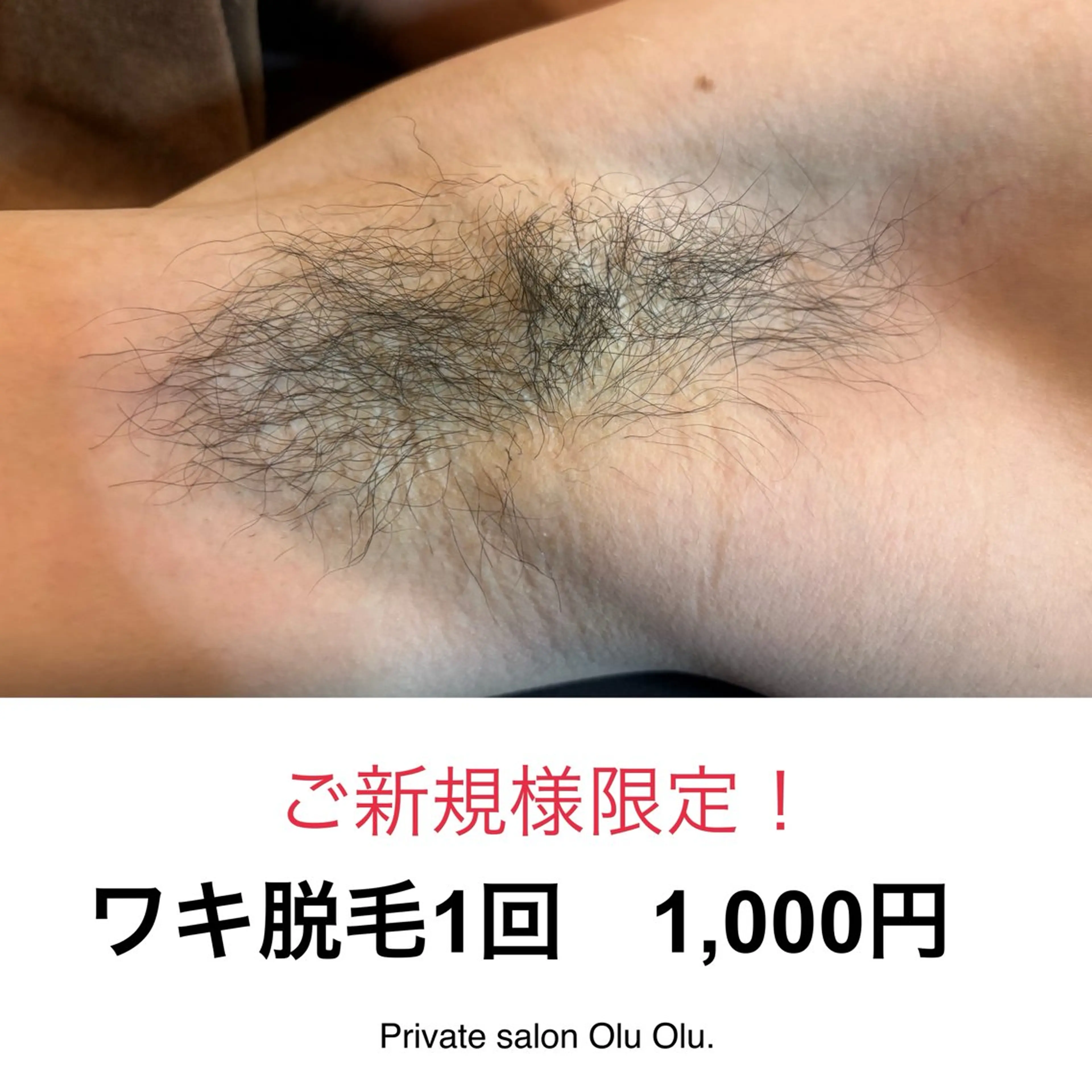 【初回限定】 ワキ脱毛1回  1,000円！の写真