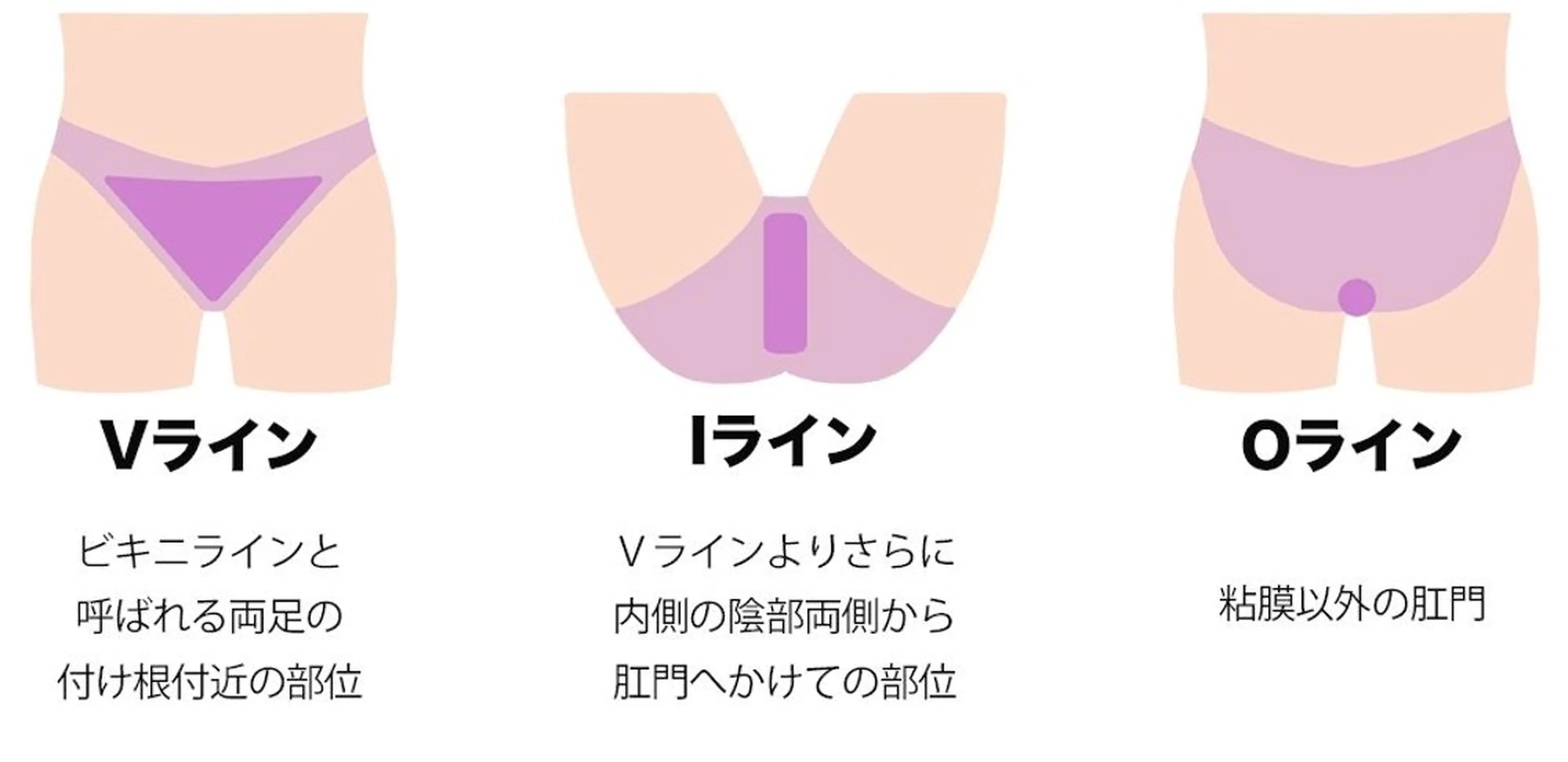 V.I.O脱毛の写真