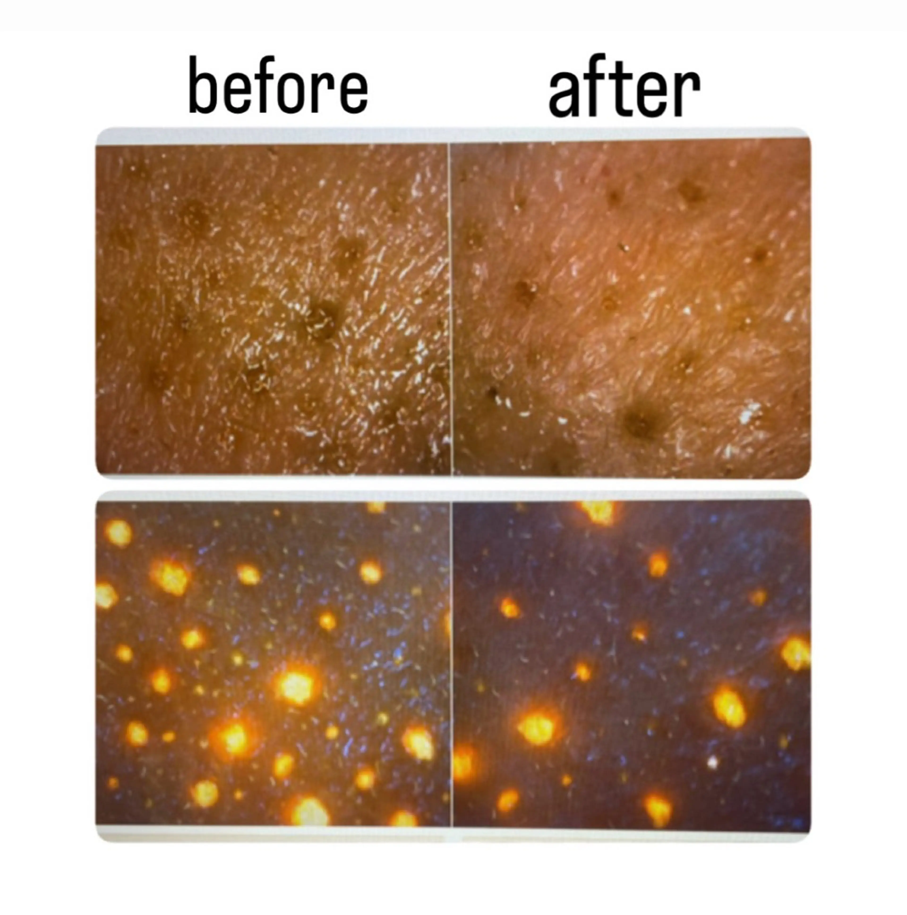 無料毛穴診断毛穴カウンセリングの写真