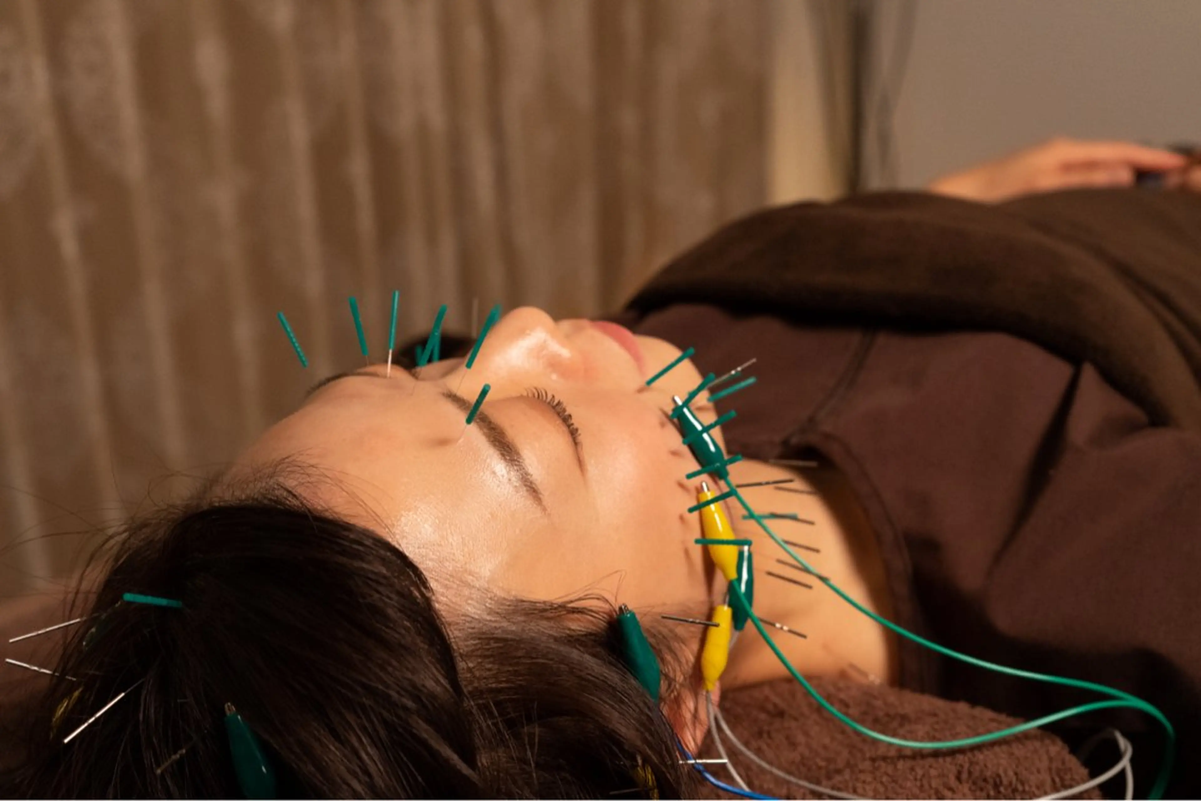 【韓国ヒロインコース】 ♥️鍼100本【お顔+全身】小顔/肩こり/巻き肩/むくみ/全身疲労を同時に🪡欲張り美容鍼90分の写真