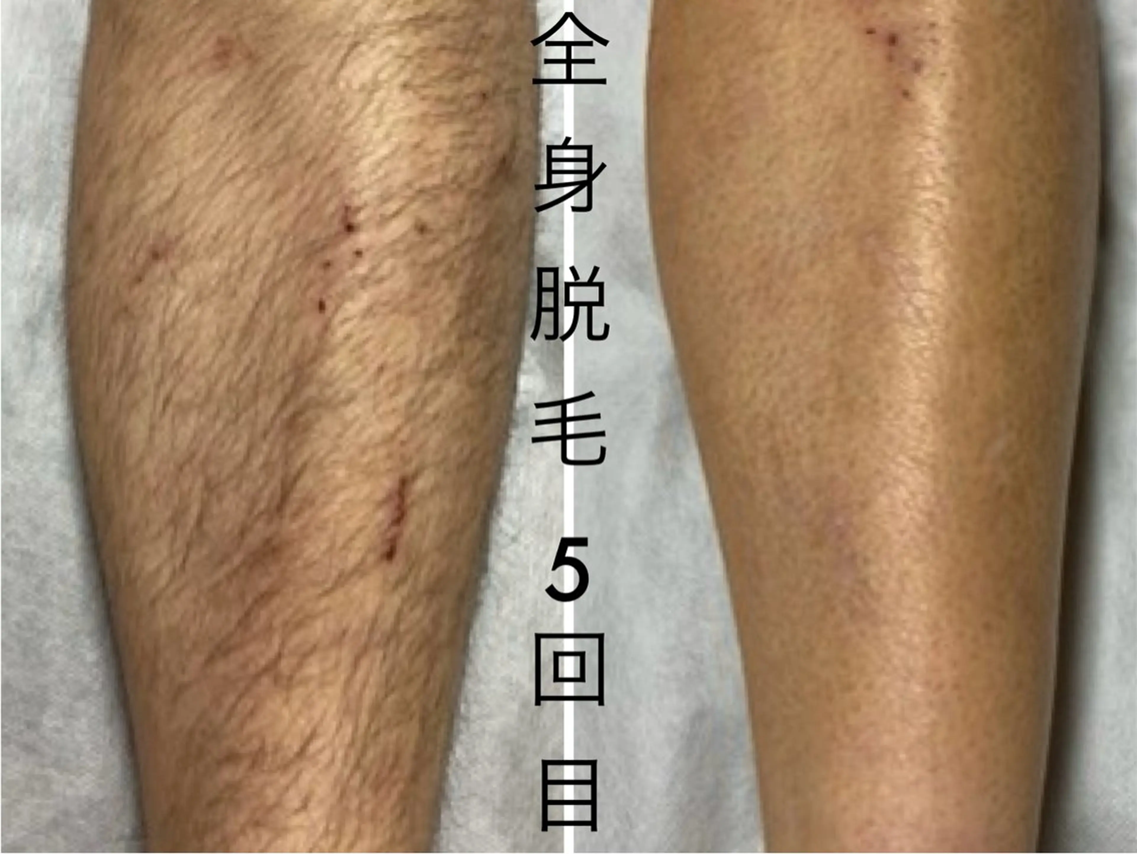 メンズ 肌管理脱毛ピーリング CDFAkasakaのエステ・リラクイメージ
