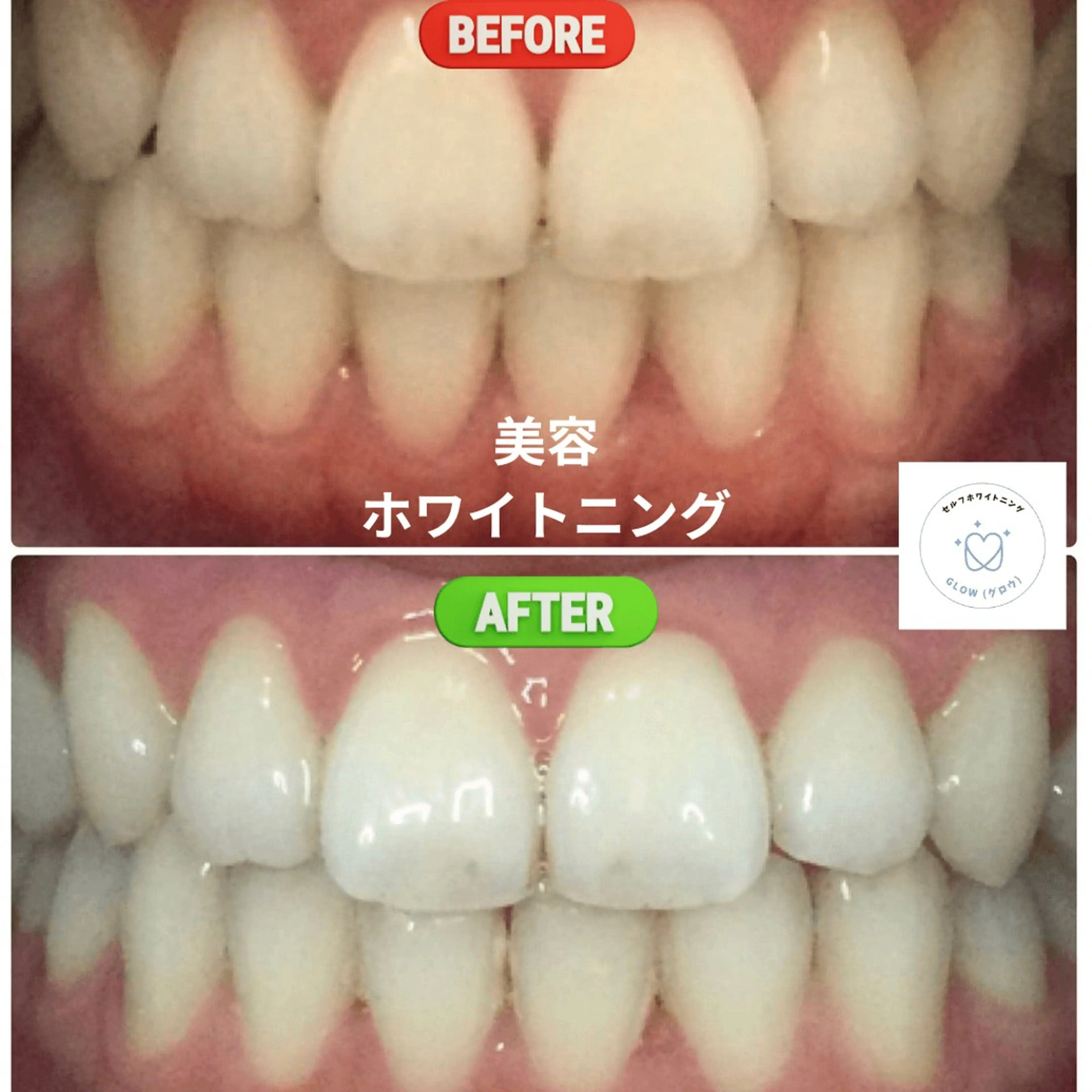 東区香椎歯のセルフホ ワイトニングGLOWのその他イメージ
