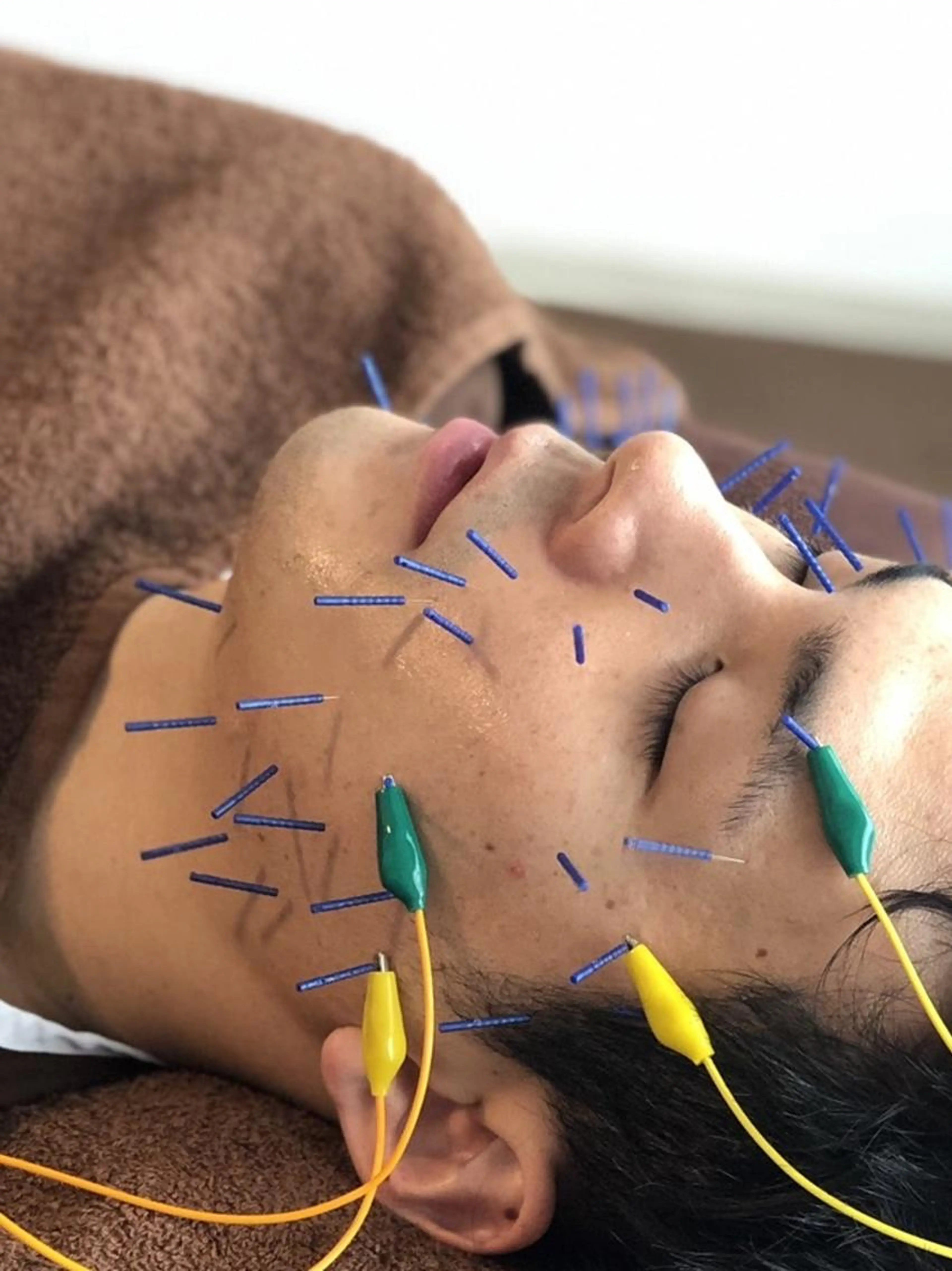 美容鍼+パーツケア90分25600円→17920円の写真