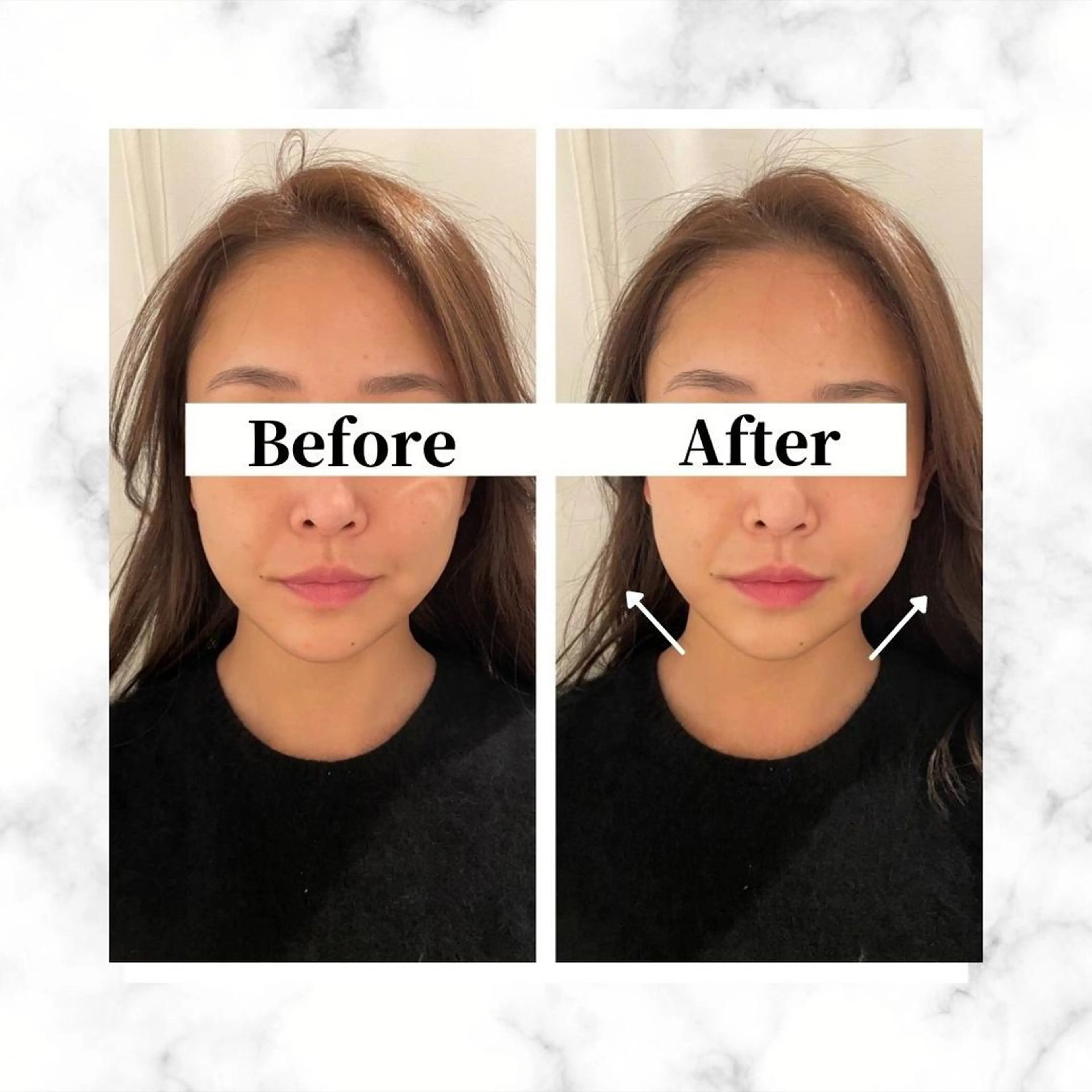 12Dハイフ💗 最強小顔のエステ・リラクイメージ