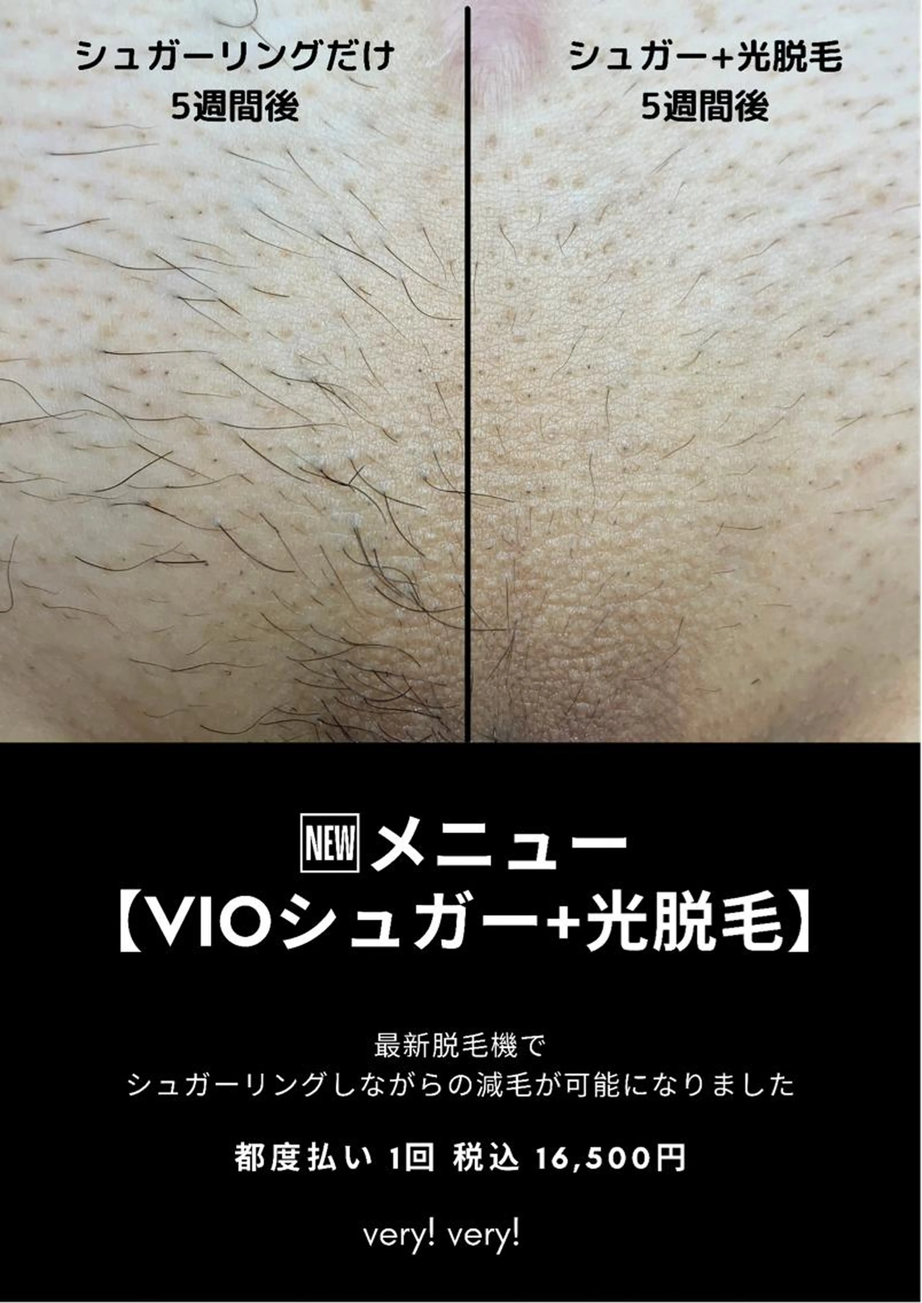 大人気！VIOシュガー＋エステ脱毛：両ワキエステ脱毛付き【女性限定】の写真