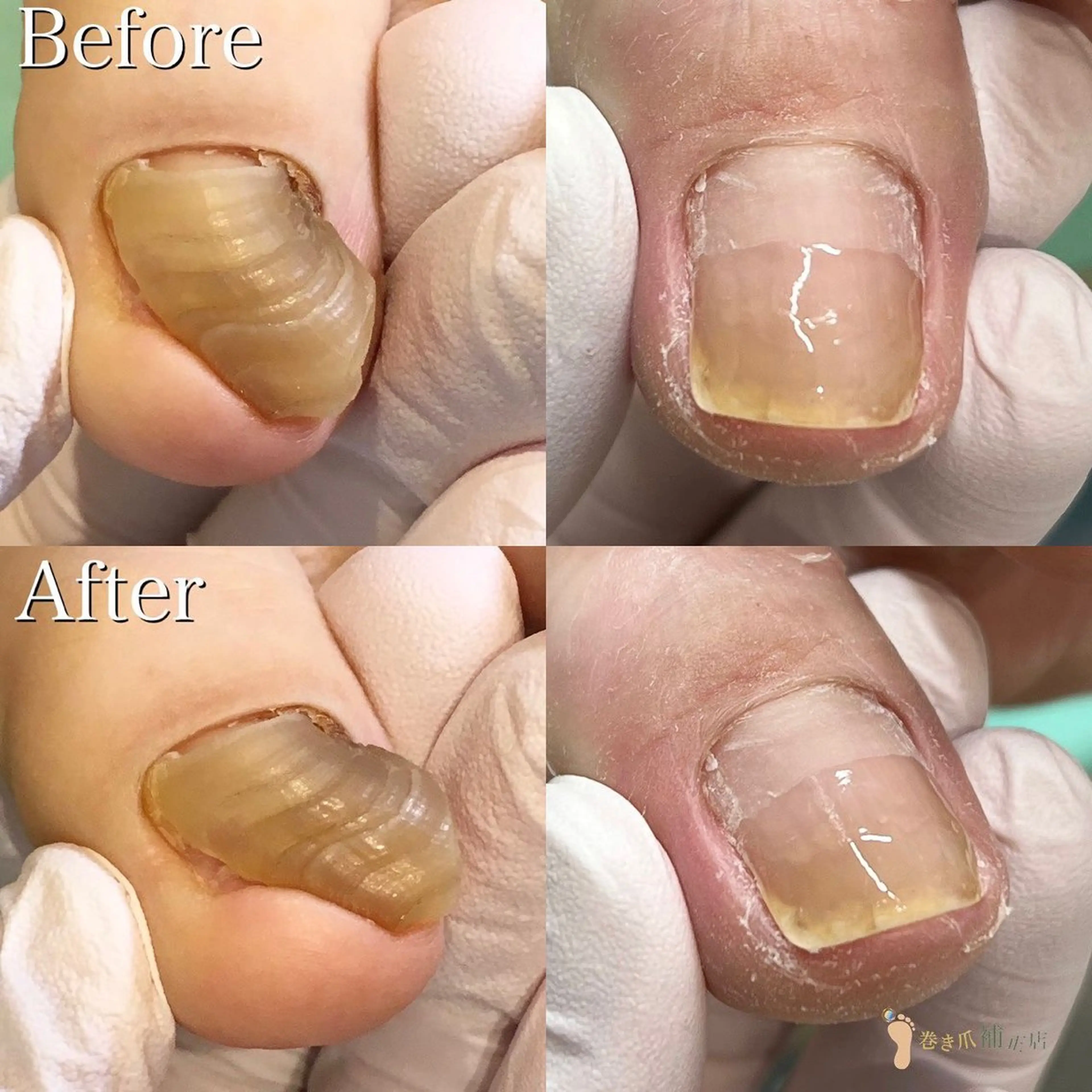 【分厚い爪・深爪補正】口コミにご協力頂ける方限定⭐︎1爪の補正✨恥ずかしくて隠していた爪😔💦綺麗に補正します🤗の写真