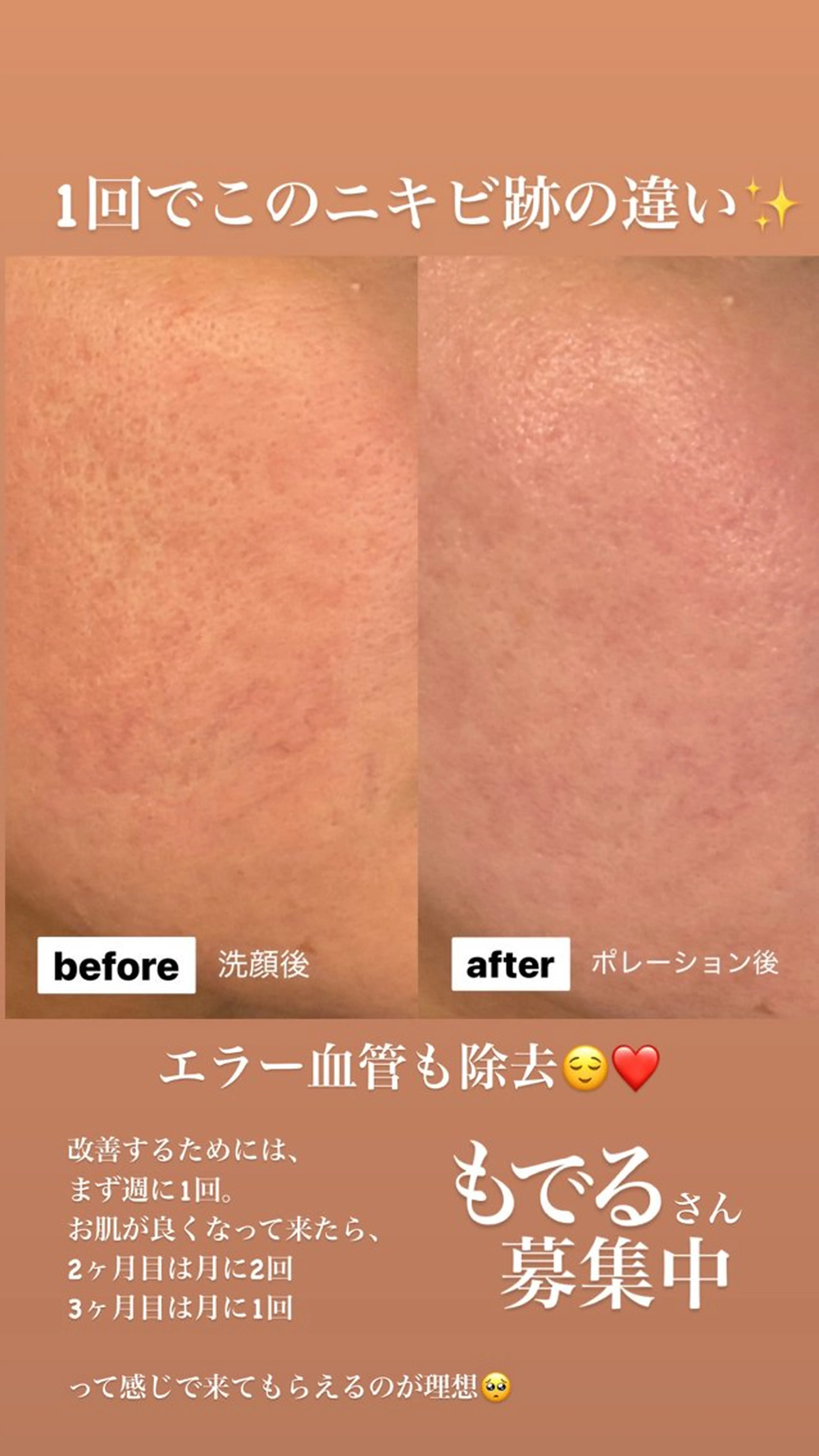 エステ Beauty salon ~Ohana~所属・【ニキビ肌改善】 肌質改善Ohanaのエステ・リラクイメージ