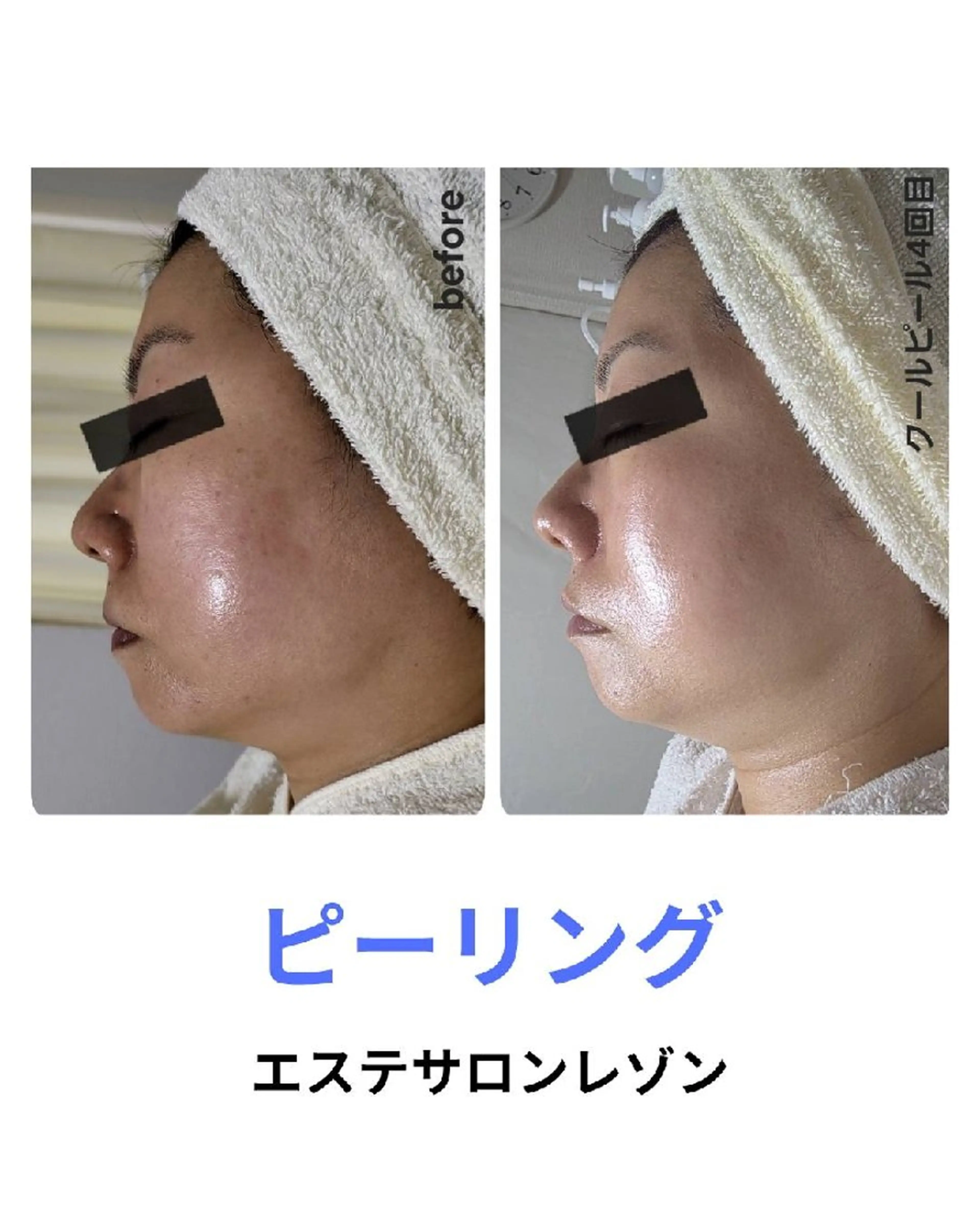 〈ニキビケアサロン〉 レゾン京橋店/ 浅川のエステ・リラクイメージ