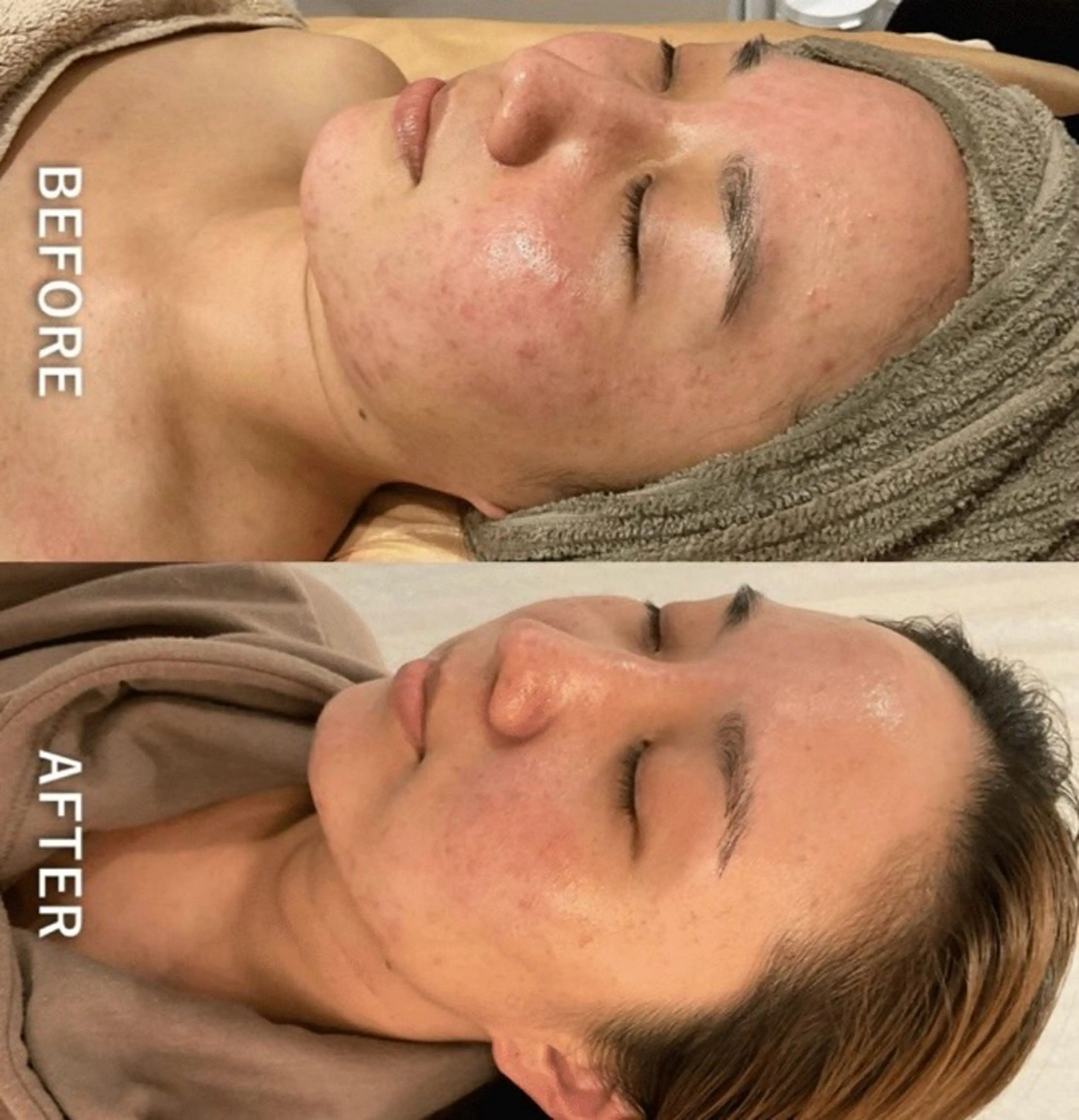 【初めての方はこちら】REVIハーブピーリング（全顔）の写真