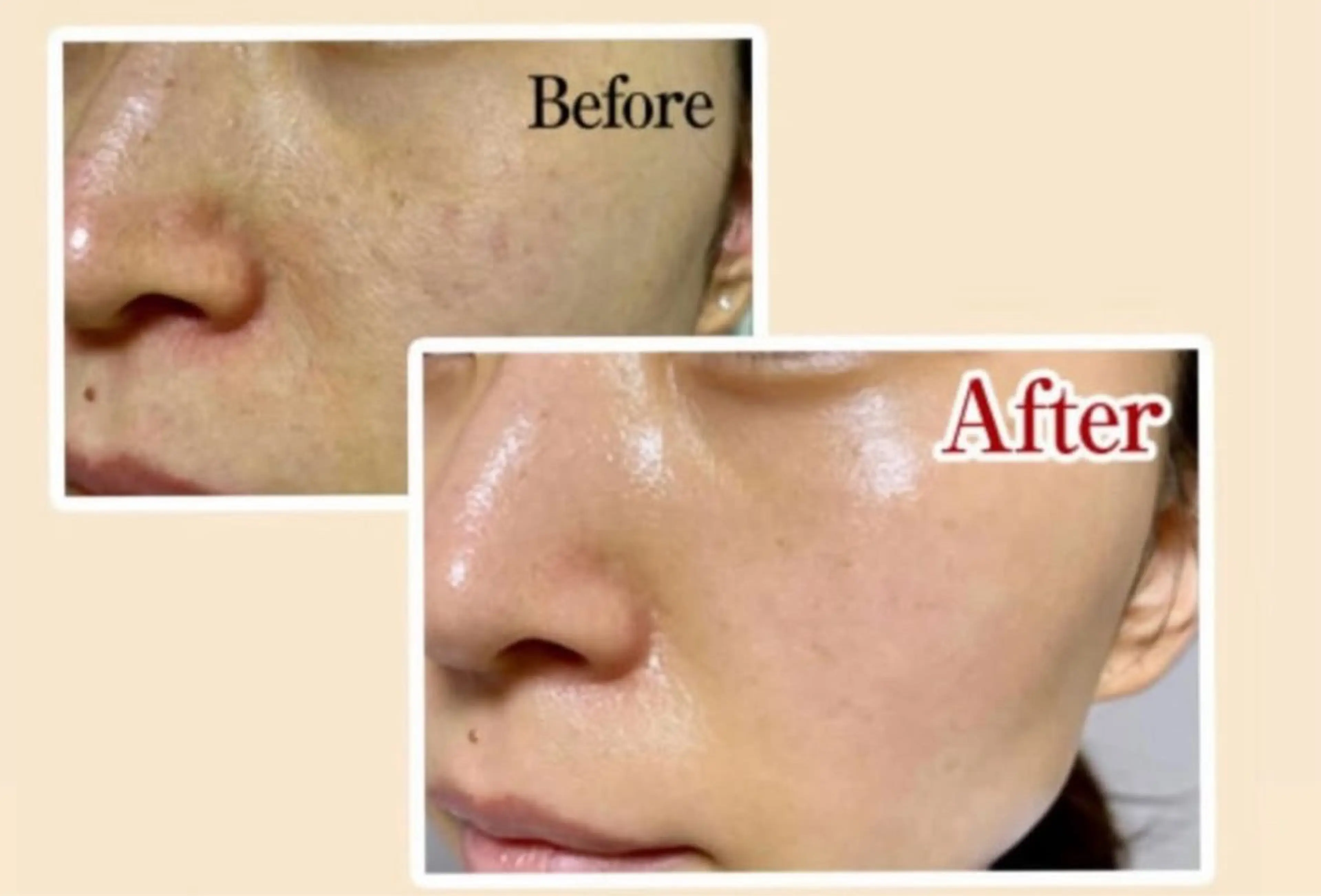 ニキビケア・水光肌！【ハーブピーリング＋高保湿うるつやパック✨】¥6980の写真