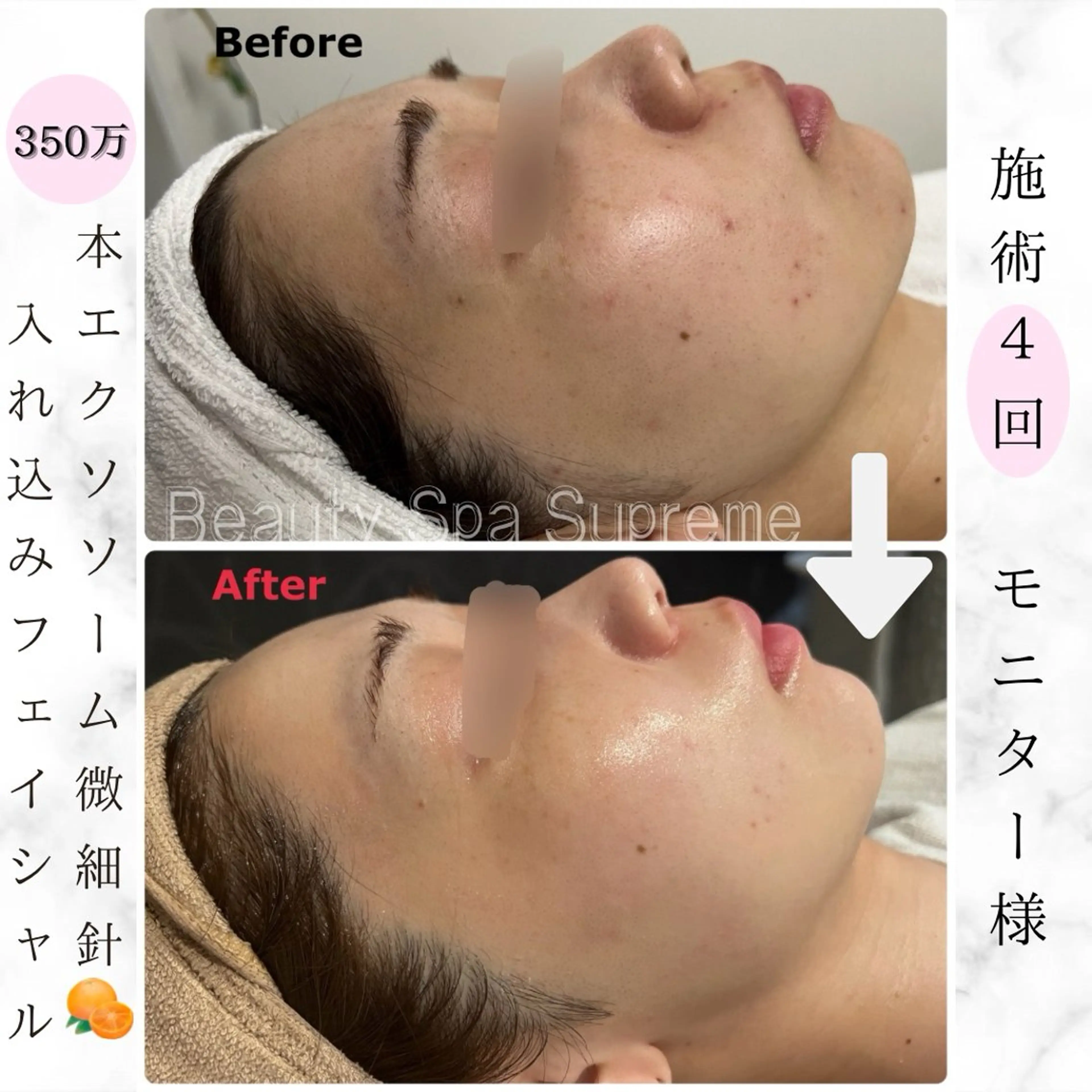 【最新韓国🇰🇷毛穴/ニキビ/小顔】350万本🍊スピキュール入込みフェイシャル60分の写真