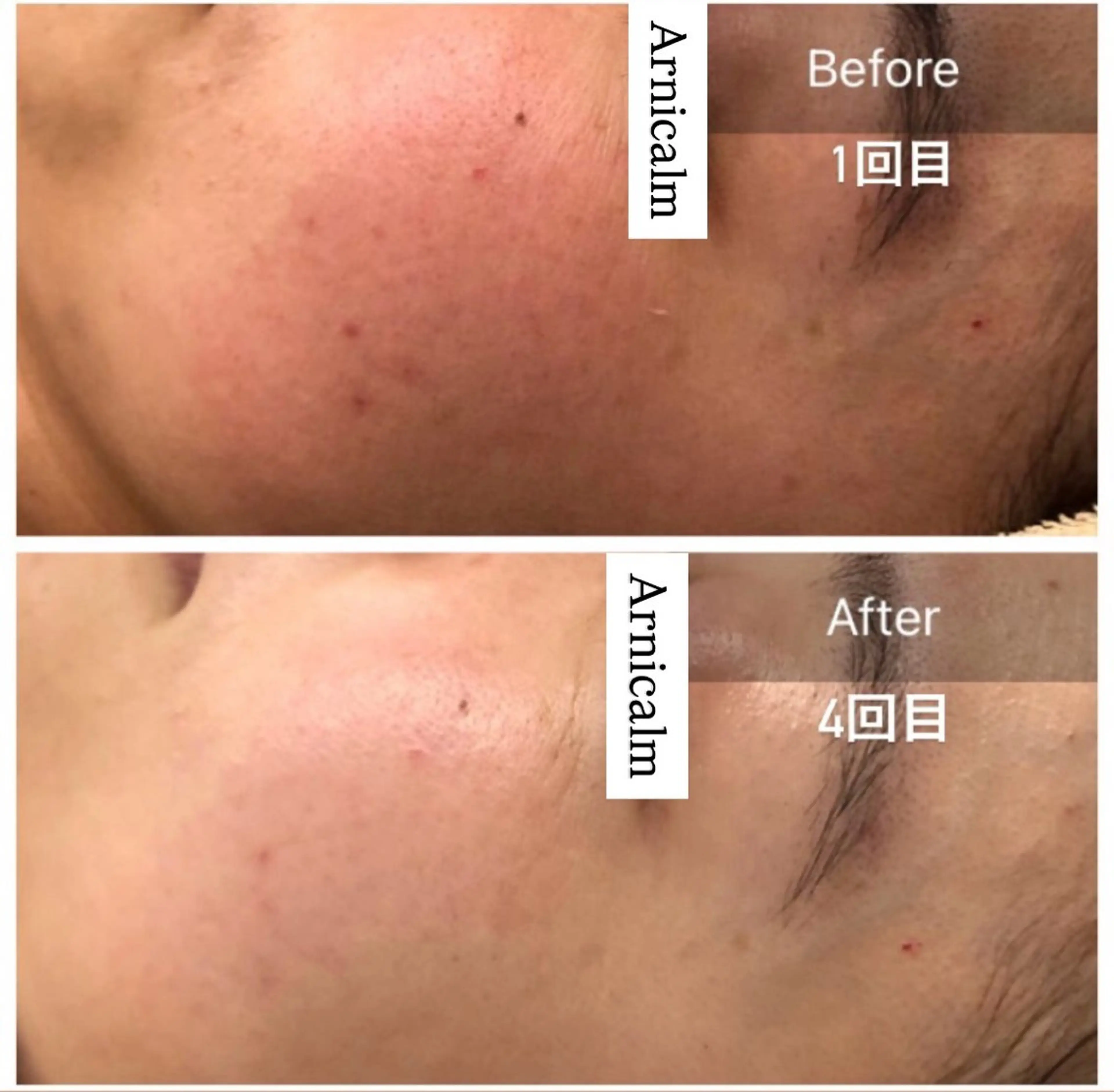 ハーブピーリング 肌再生ピーリング/のエステ・リラクイメージ