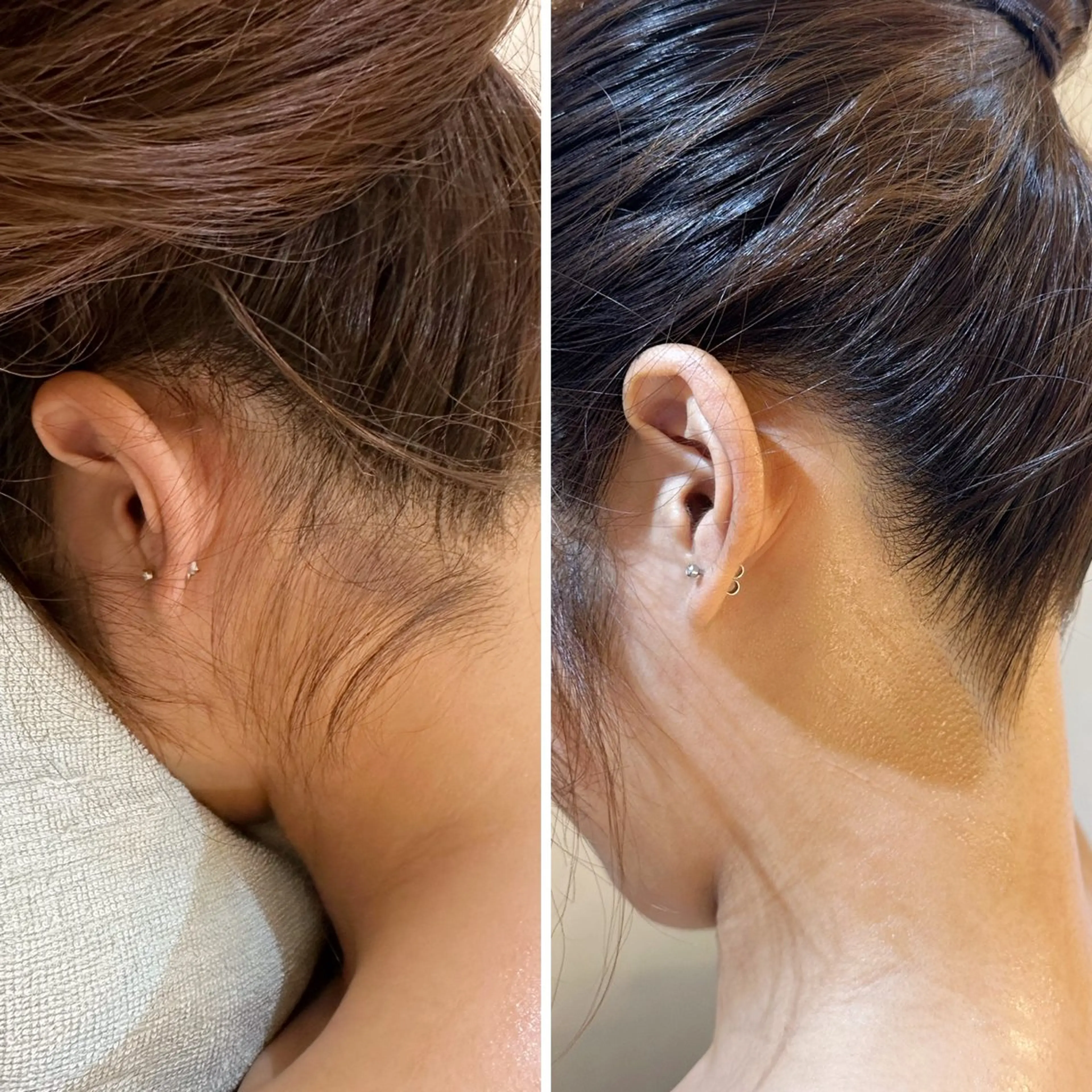 脱毛 うなじ脱毛/美肌脱毛 LABELのエステ・リラクイメージ