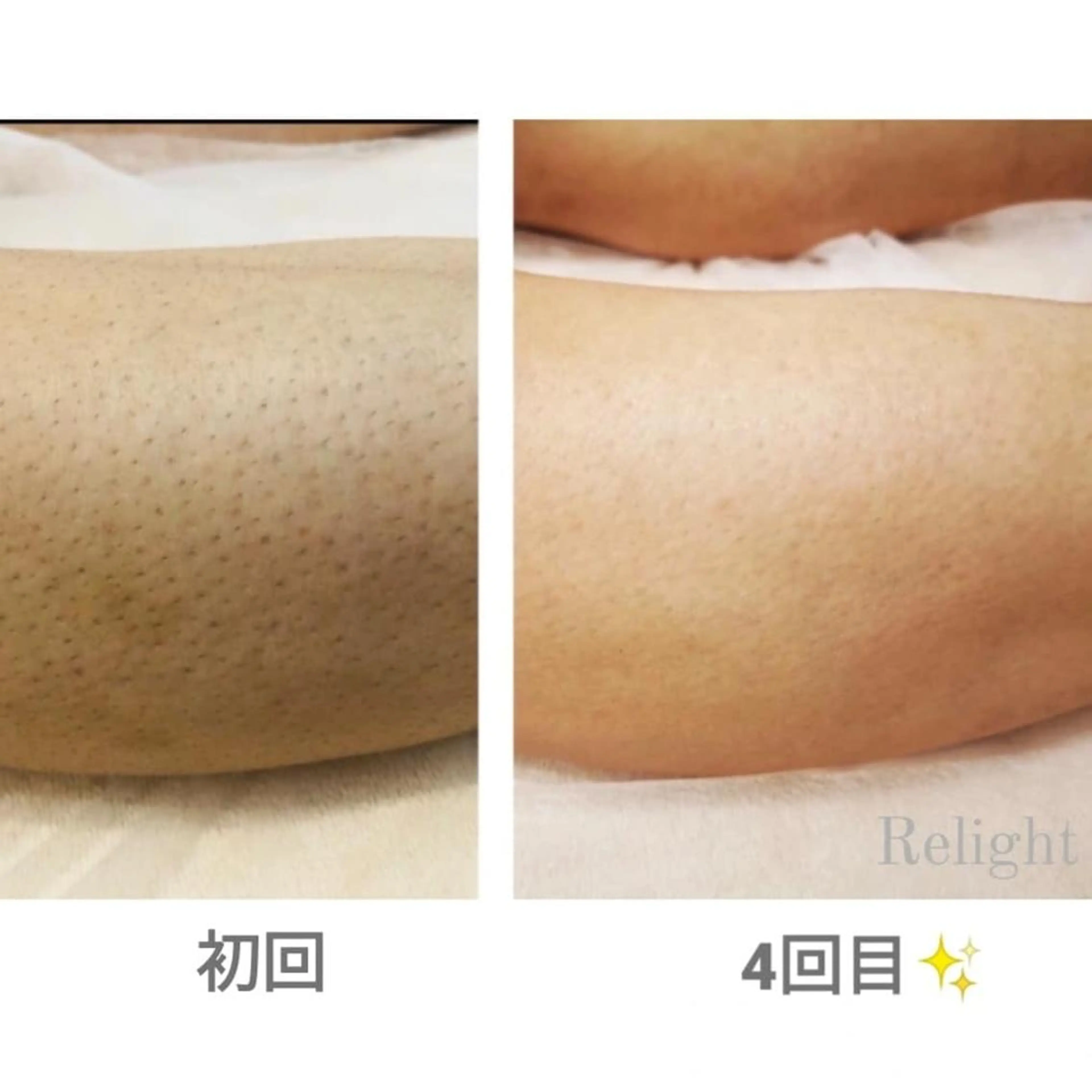 メンズ 脱毛 Relight あかりのエステ・リラクイメージ