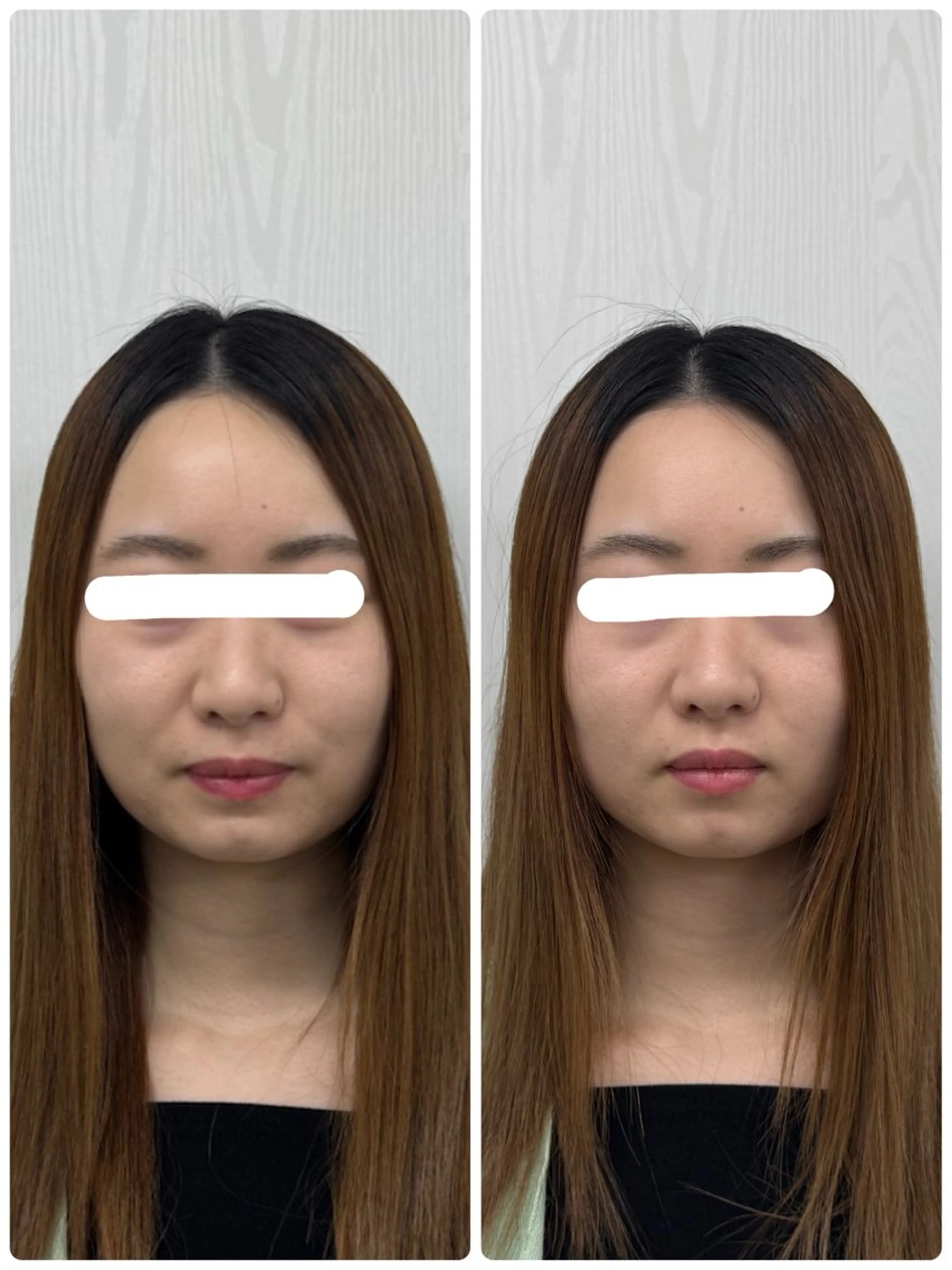 エステ 美容鍼×小顔矯正 ×美容整体　浜川泰仁のエステ・リラクイメージ