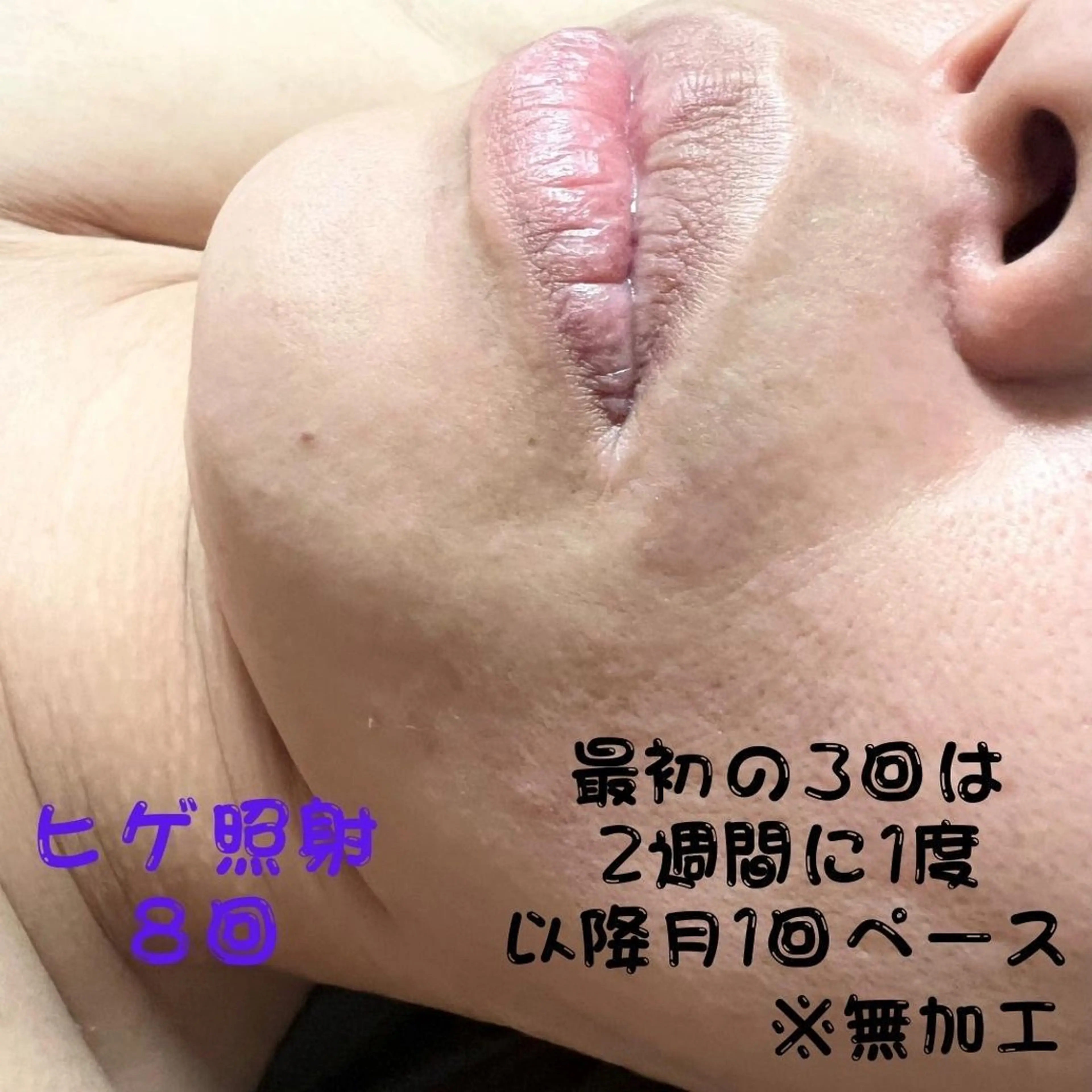 メンズ キッズ 脱毛 メンズ脱毛フェリッセ /男女🆗キッズ🆗のエステ・リラクイメージ