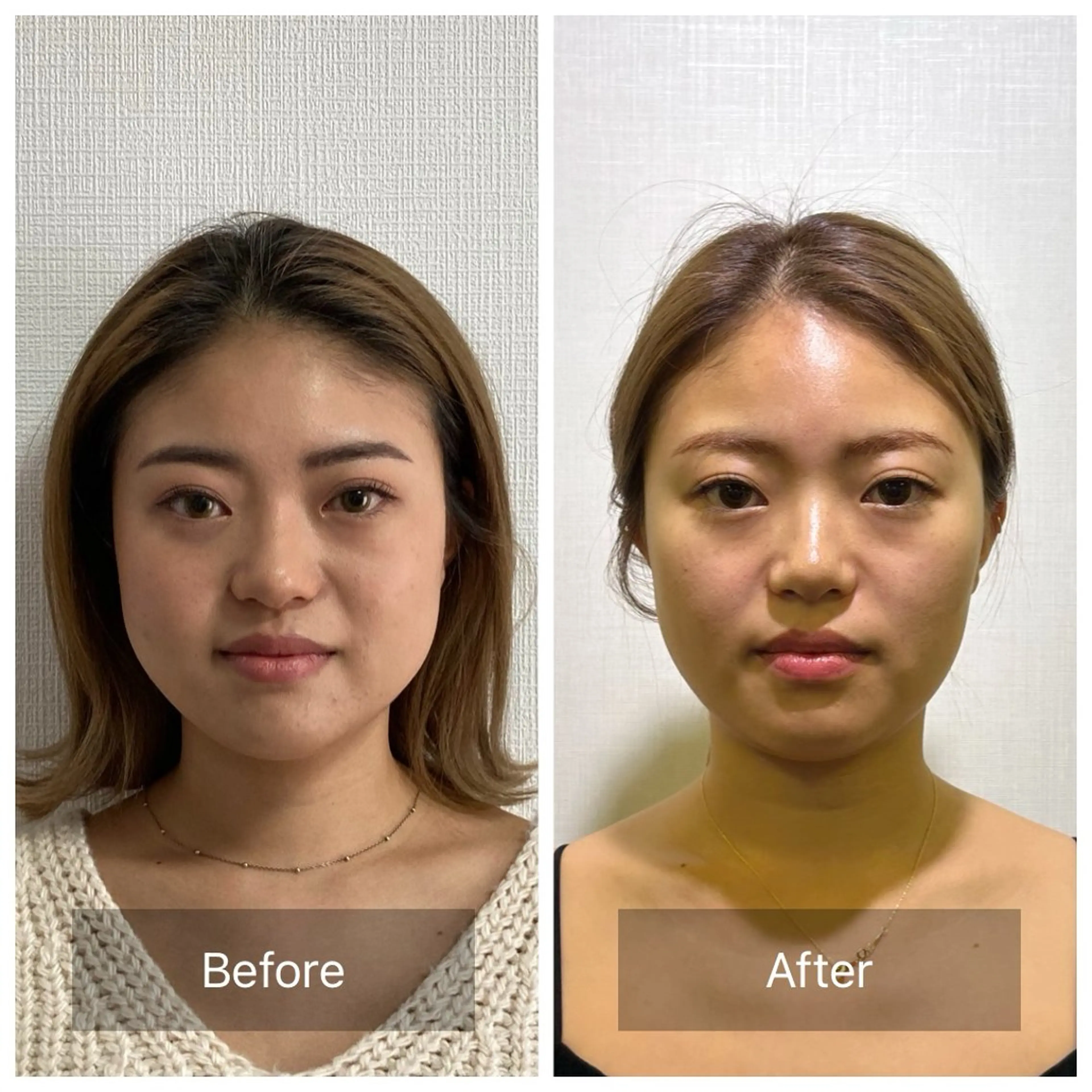 【美容鍼初心者限定！劇的むくみ&たるみケア☆】美容鍼×小顔矯正 ¥7,980→¥4,980の写真