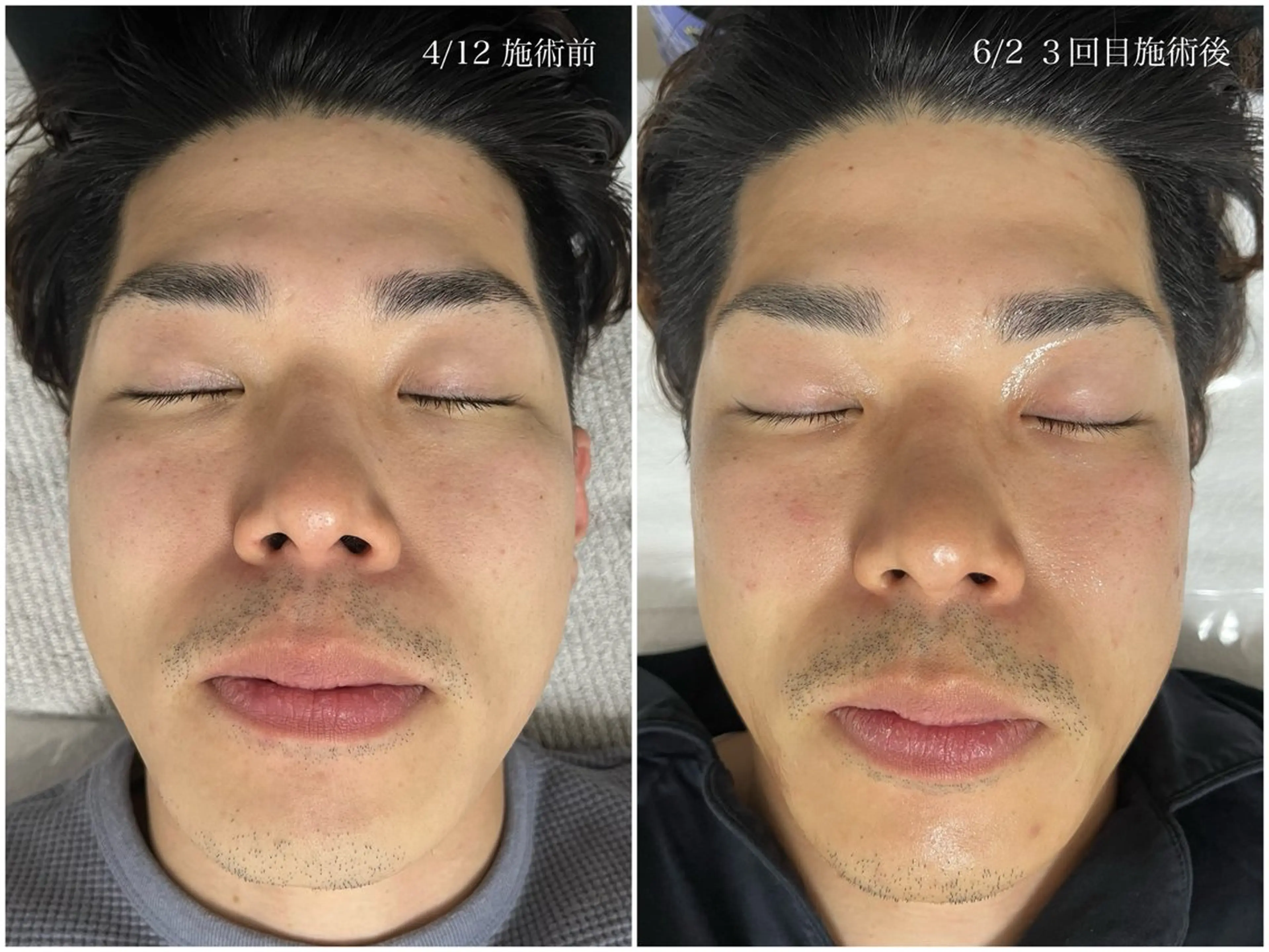 【肌質改善No.1】プラズマスキン（ニキビ/シミ/毛穴）の写真