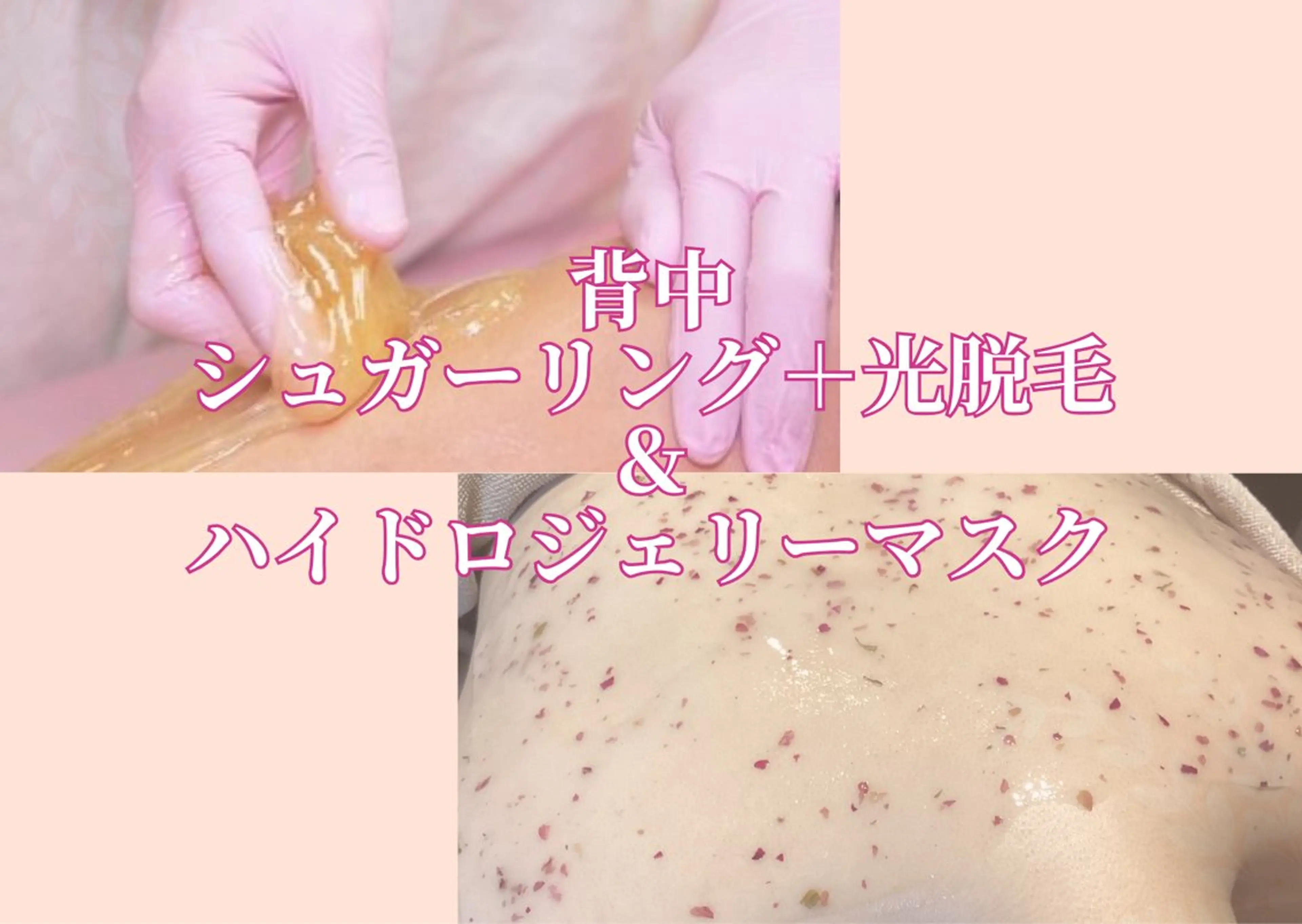 背中ケアはコレ✌️【ダブル脱毛】背中上部　シュガーリング＋光脱毛＋ハイドロジェリーマスク　集中美肌ケア⭐️の写真