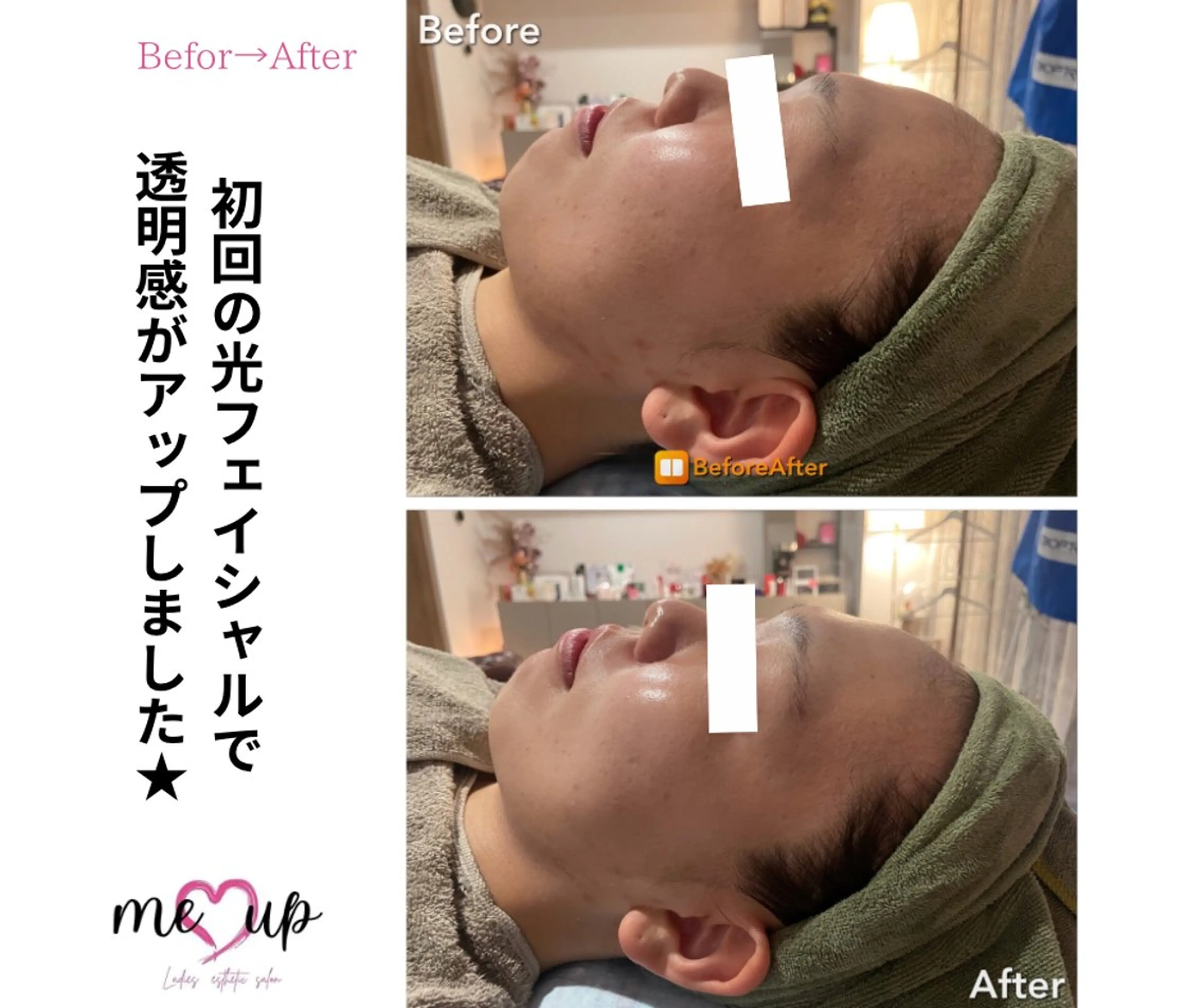 エステ Meupニキビ専門店 背中/ハーブ/肌管理のその他イメージ