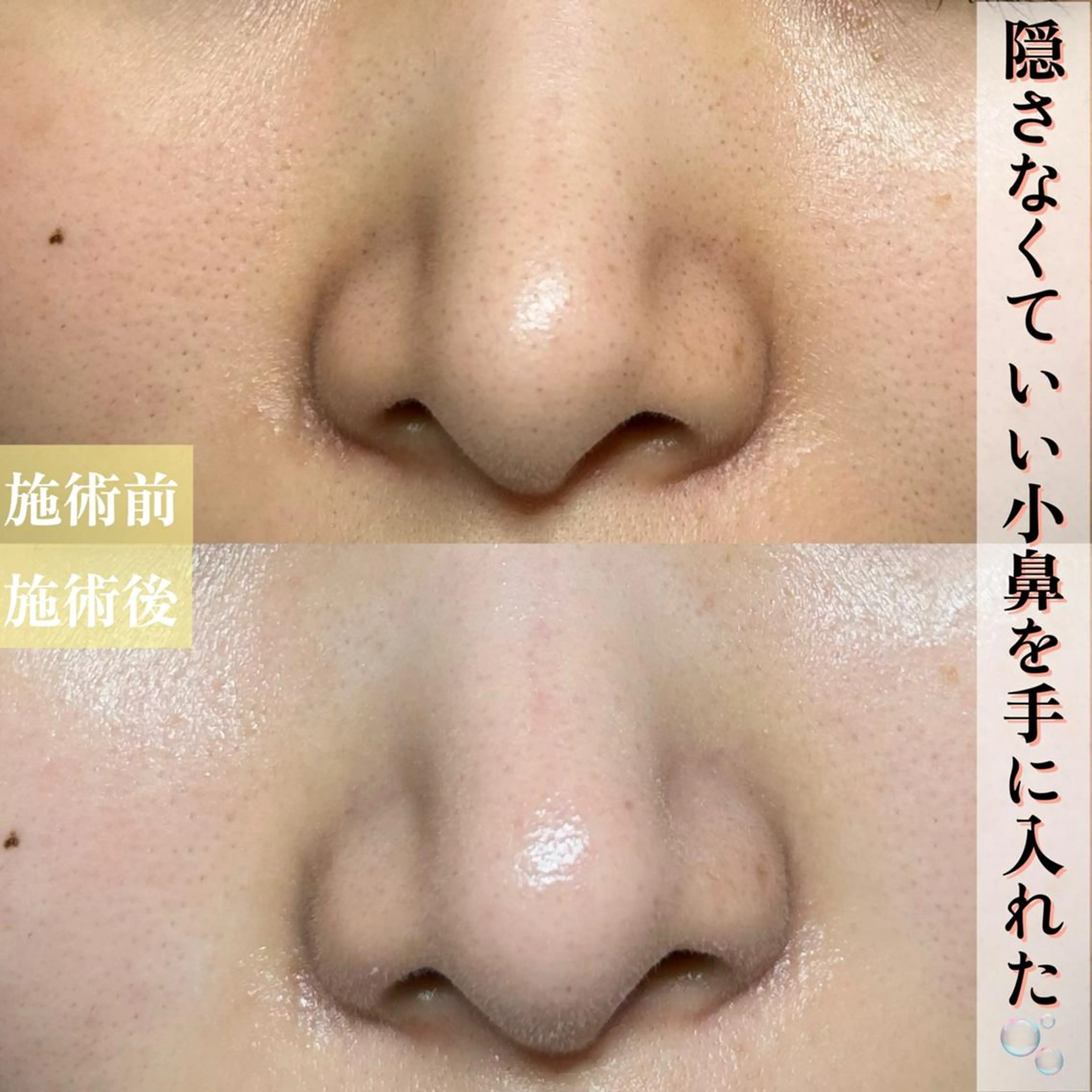 【お試し毛穴洗浄】鼻ハイドラの写真