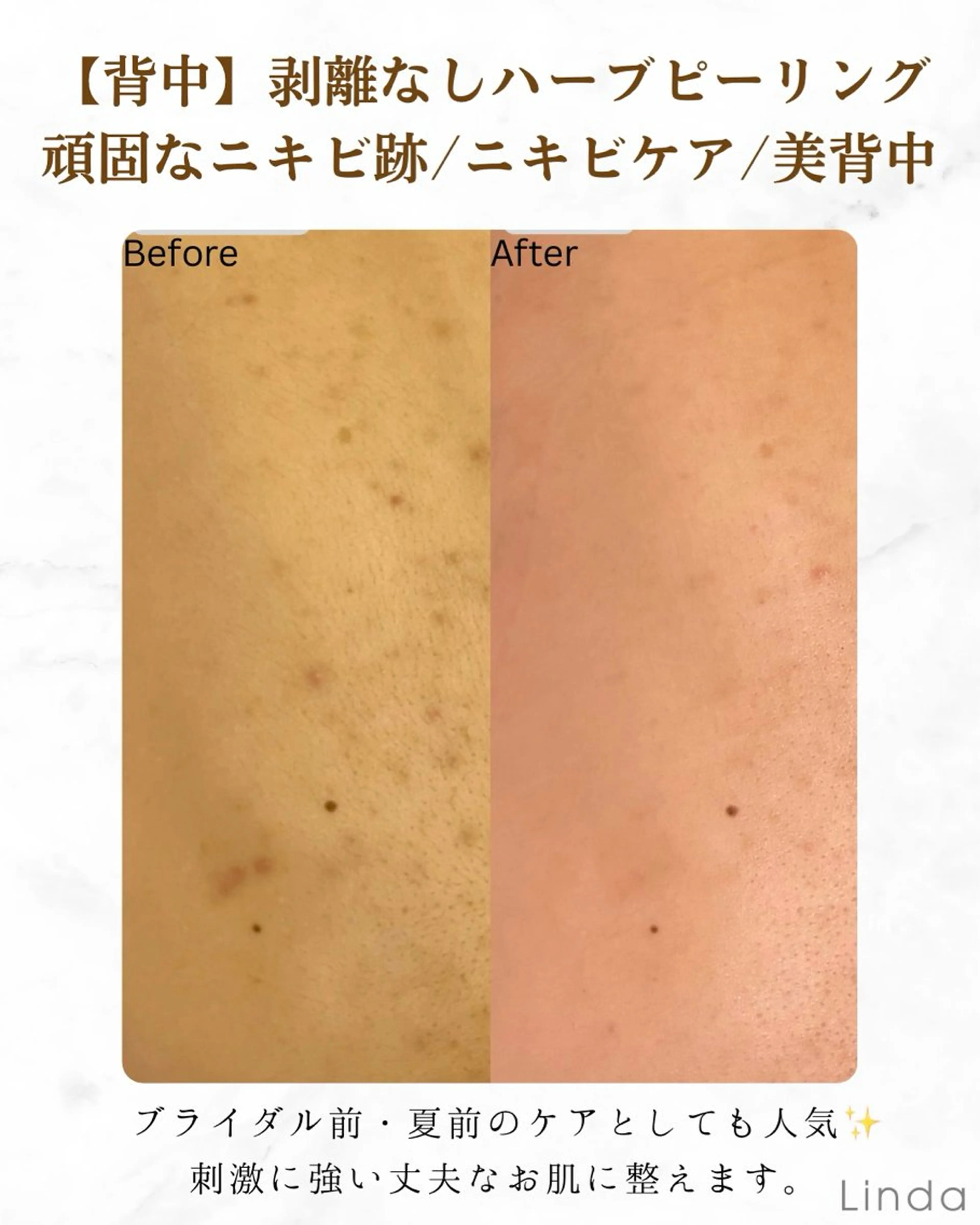 エステ 小顔&毛穴・肌質改善 LINDA西宮 AIのエステ・リラクイメージ