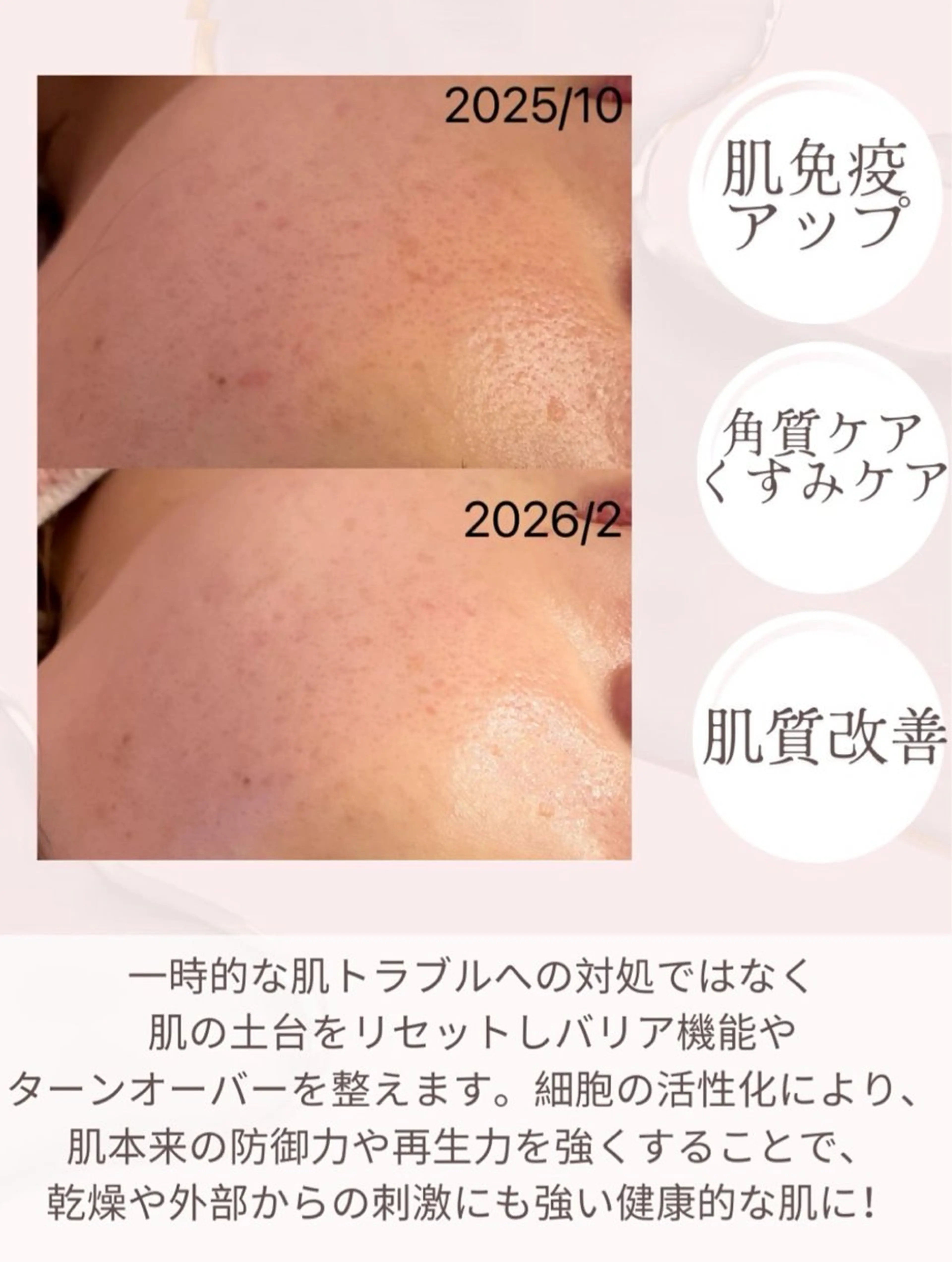 エステ 小顔&毛穴・肌質改善 LINDA西宮 AIのエステ・リラクイメージ