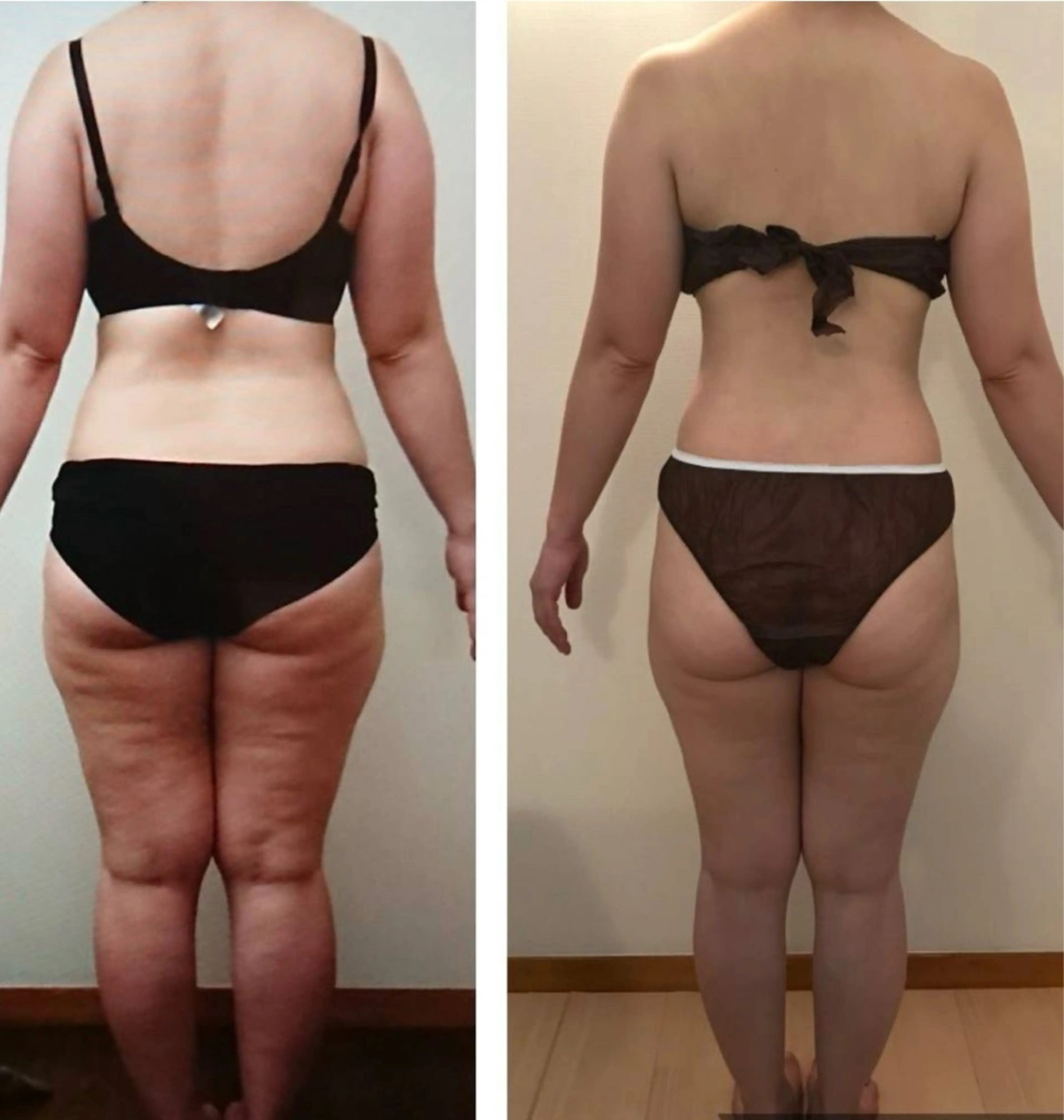 通常44000円‼️夏に向け本気で痩せたい方必見‼️本気痩せ2回セット！歴10年以上のスタッフの超本格痩身✨の写真