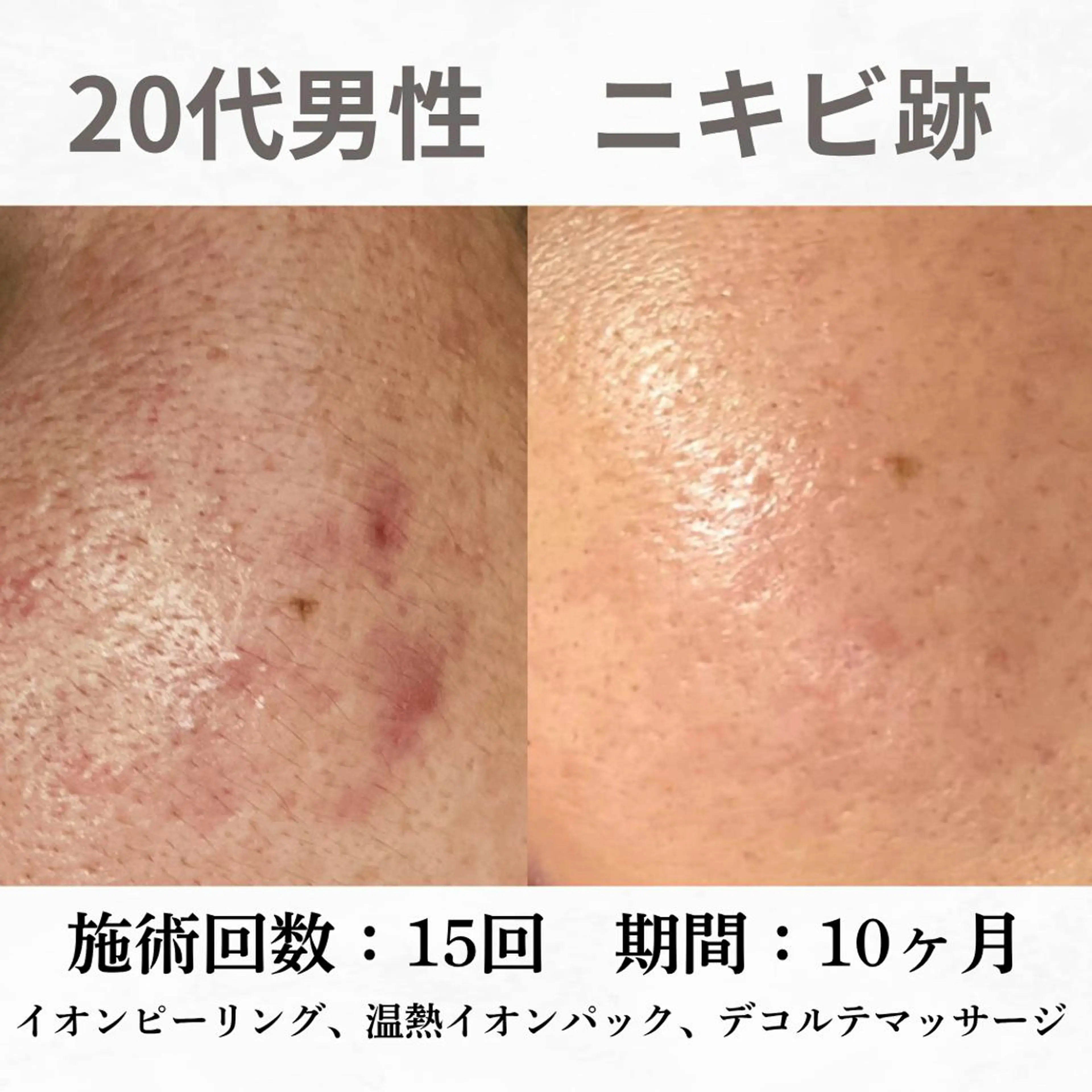 重度ニキビ専門🌷 ダウンタイムなしのエステ・リラクイメージ