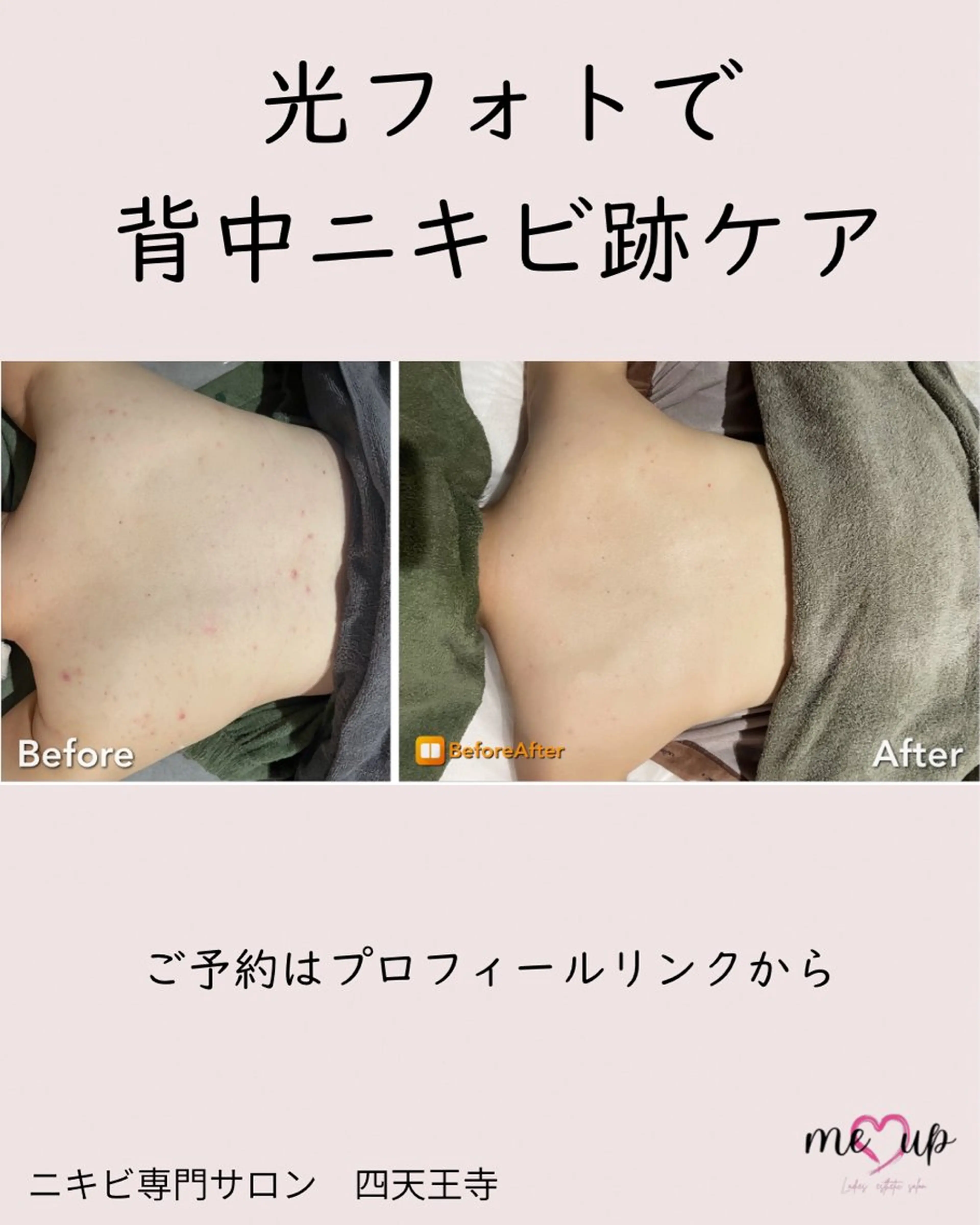 エステ Meupニキビ専門店 背中/ハーブ/肌管理のその他イメージ