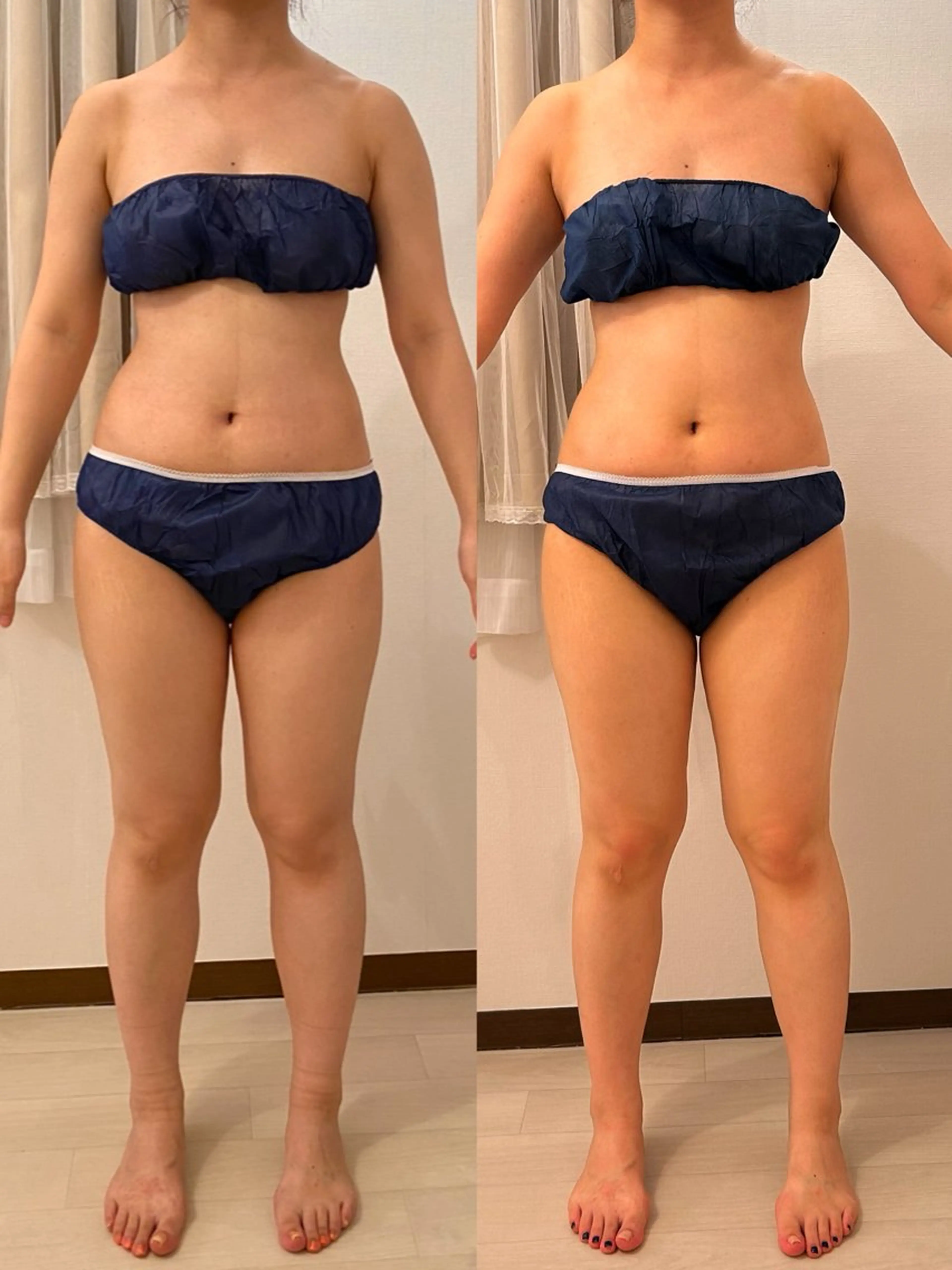 ⭐️速攻痩せダイエット痩身❤️🔥キャビゼロ90分の写真