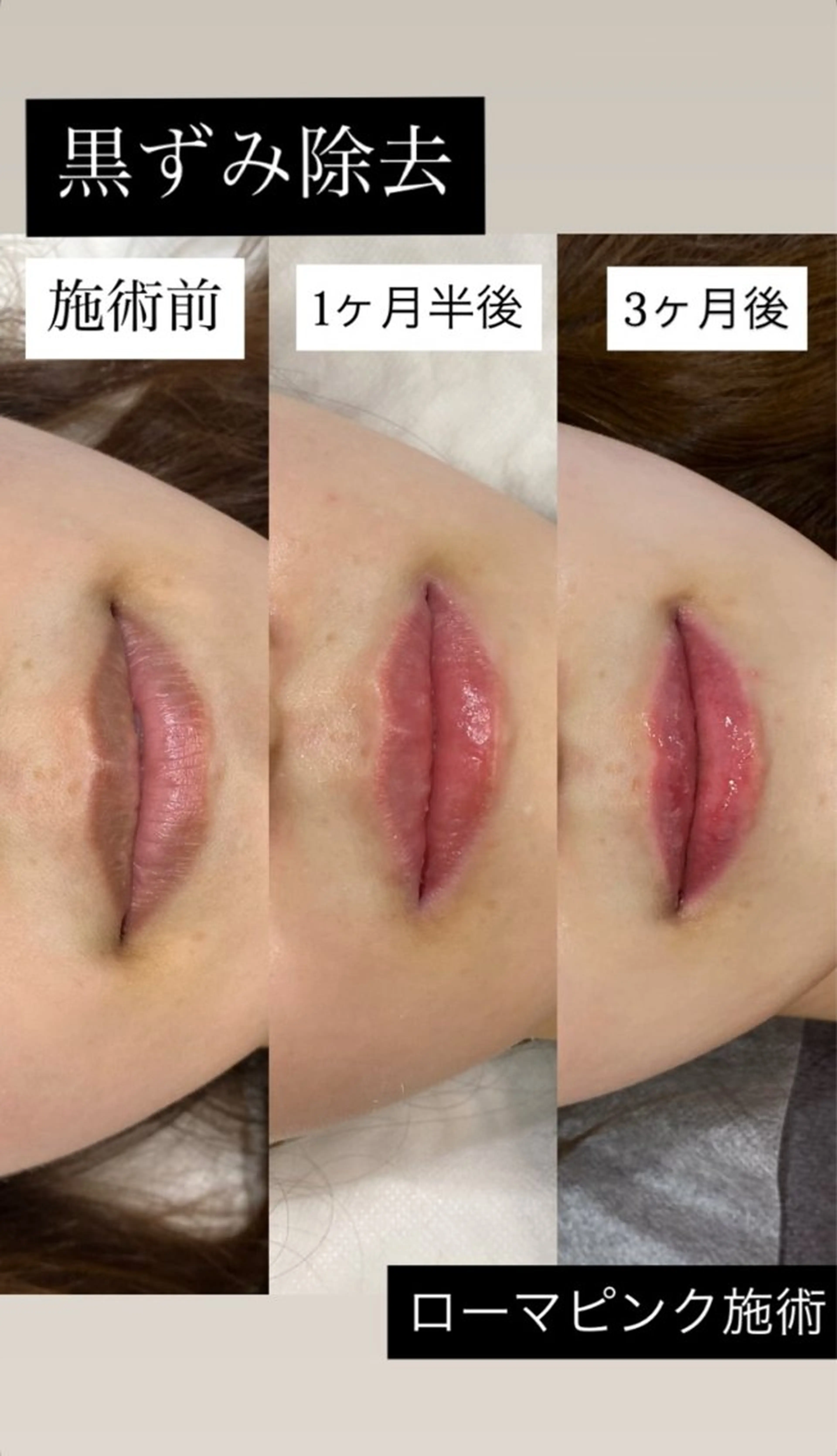 🩷人気沸騰中のローマピンク🩷まずはカウンセリングにどうぞ🫧の写真