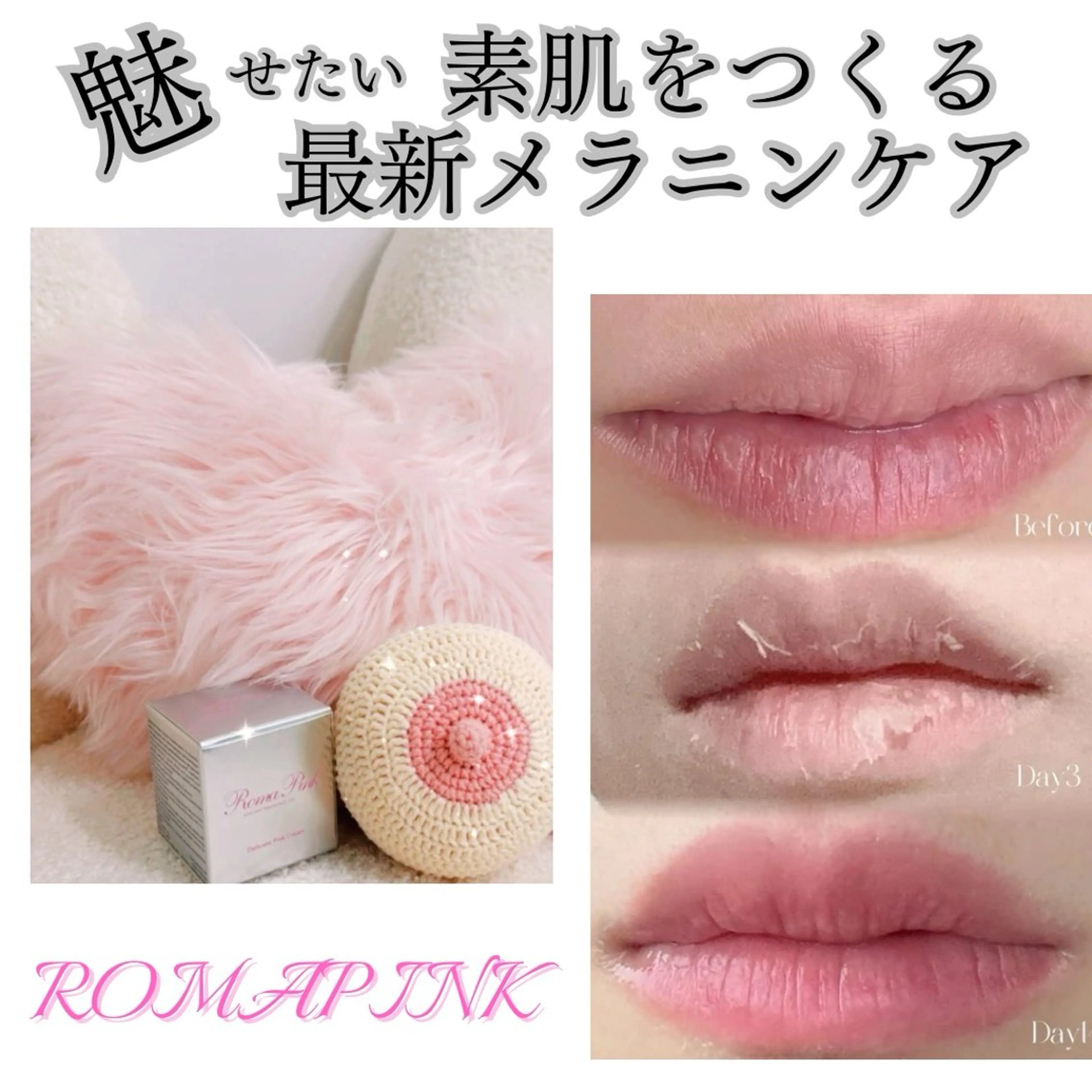 韓国大人気🇰🇷ローマピンク🩷無料カウンセリング☀️当日施術可能✨唇/バスト/VIO/ビキニライン(メラニン除去)の写真