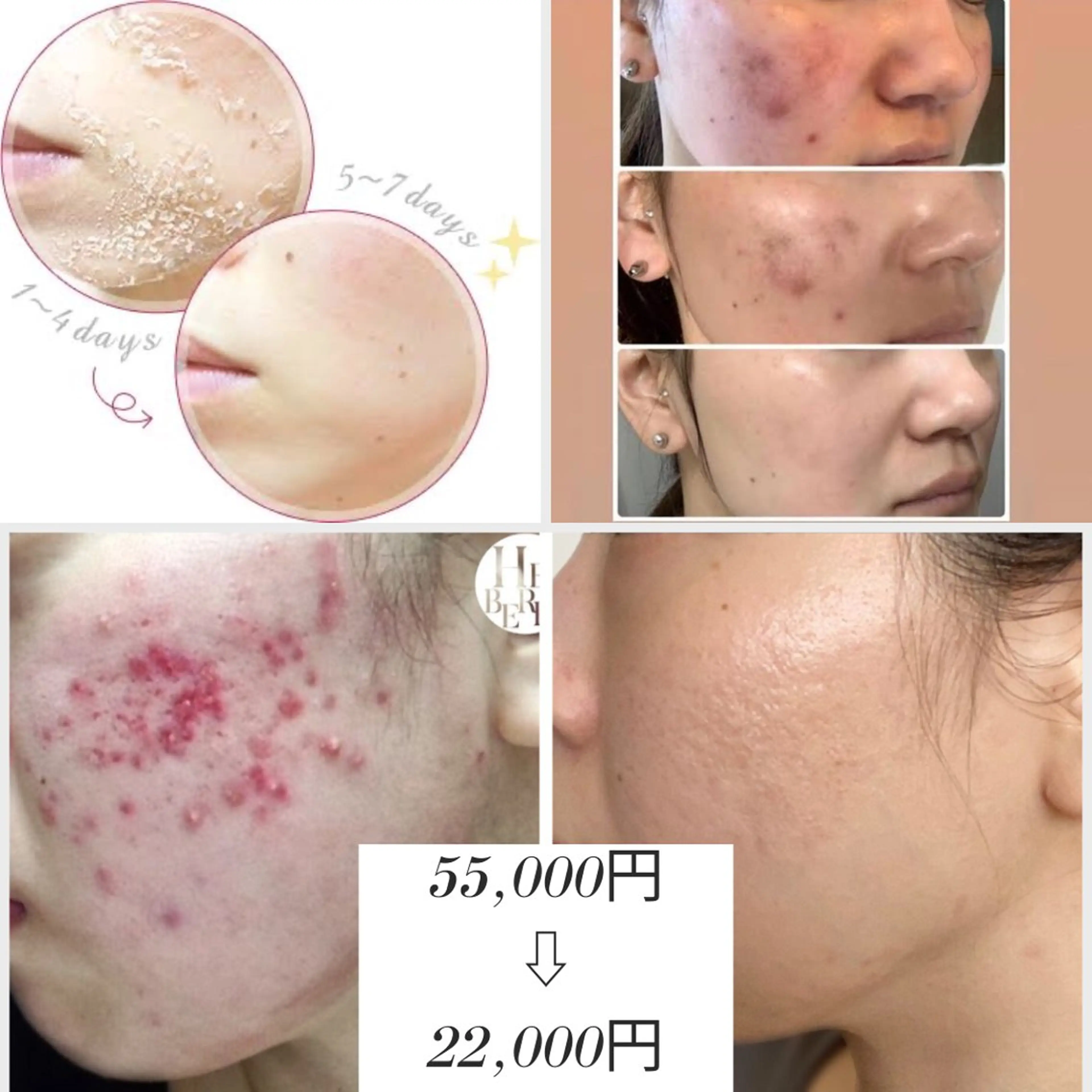 人気No.1🧡ハーブ界1の肌結果FCR/リベル剥離ありハーブピーリング🌿クレーター、ニキビ跡はこちらのコースを!の写真