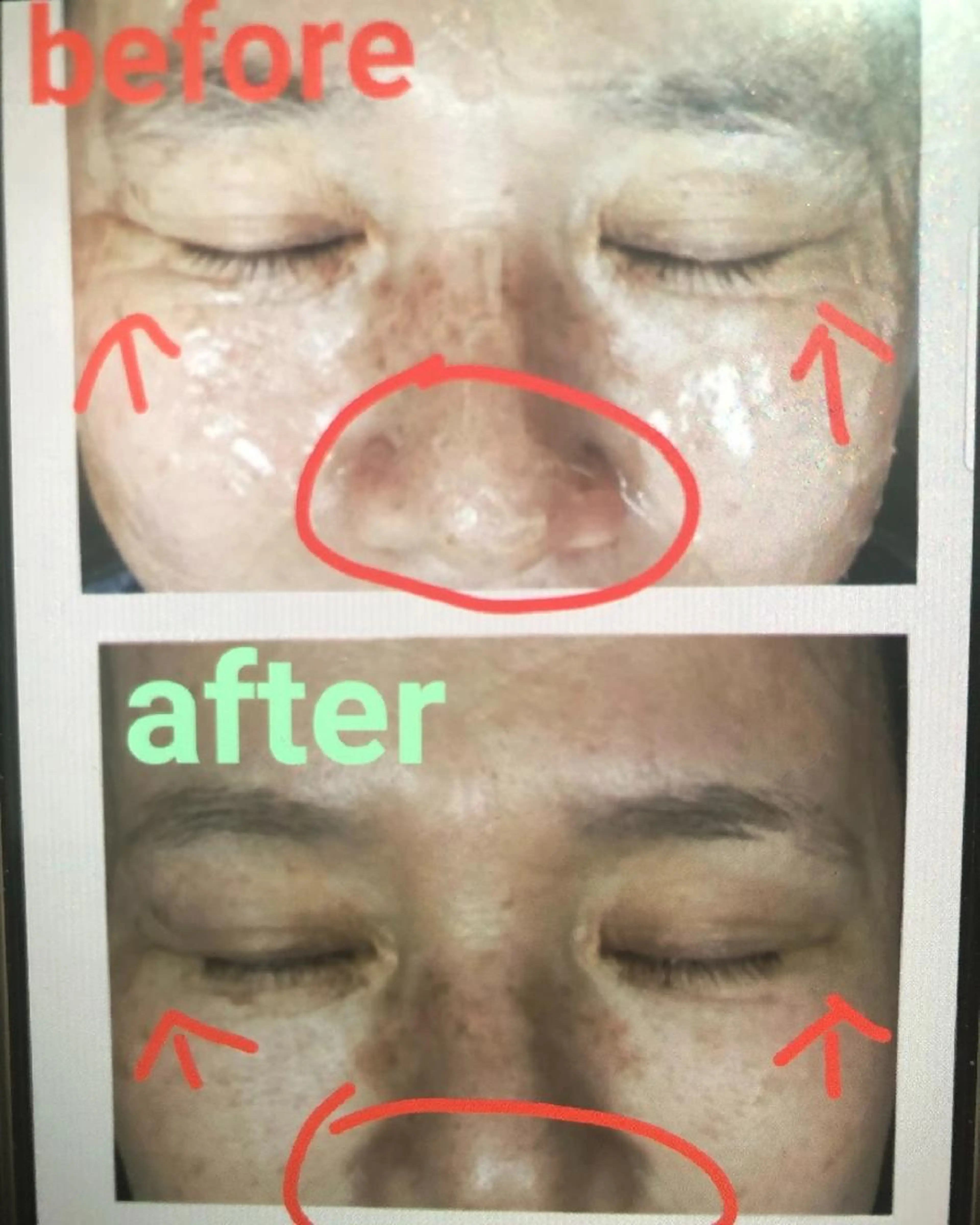 大人気♪最新BBL光フェイシャル☆もちもちお肌 ¥18000→¥5500の写真