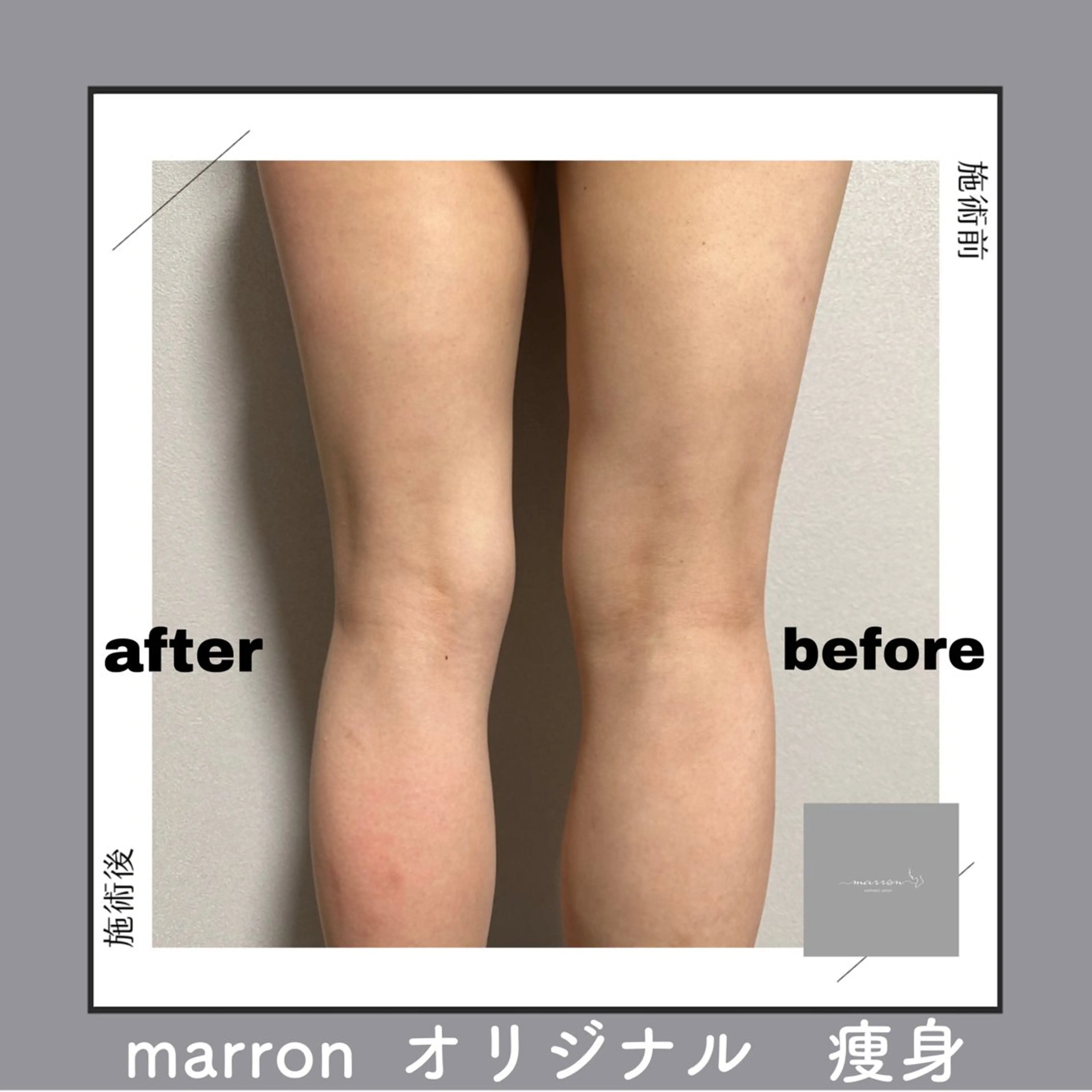 痩身ハイパーナイフ ララピールリアボーテのエステ・リラクイメージ