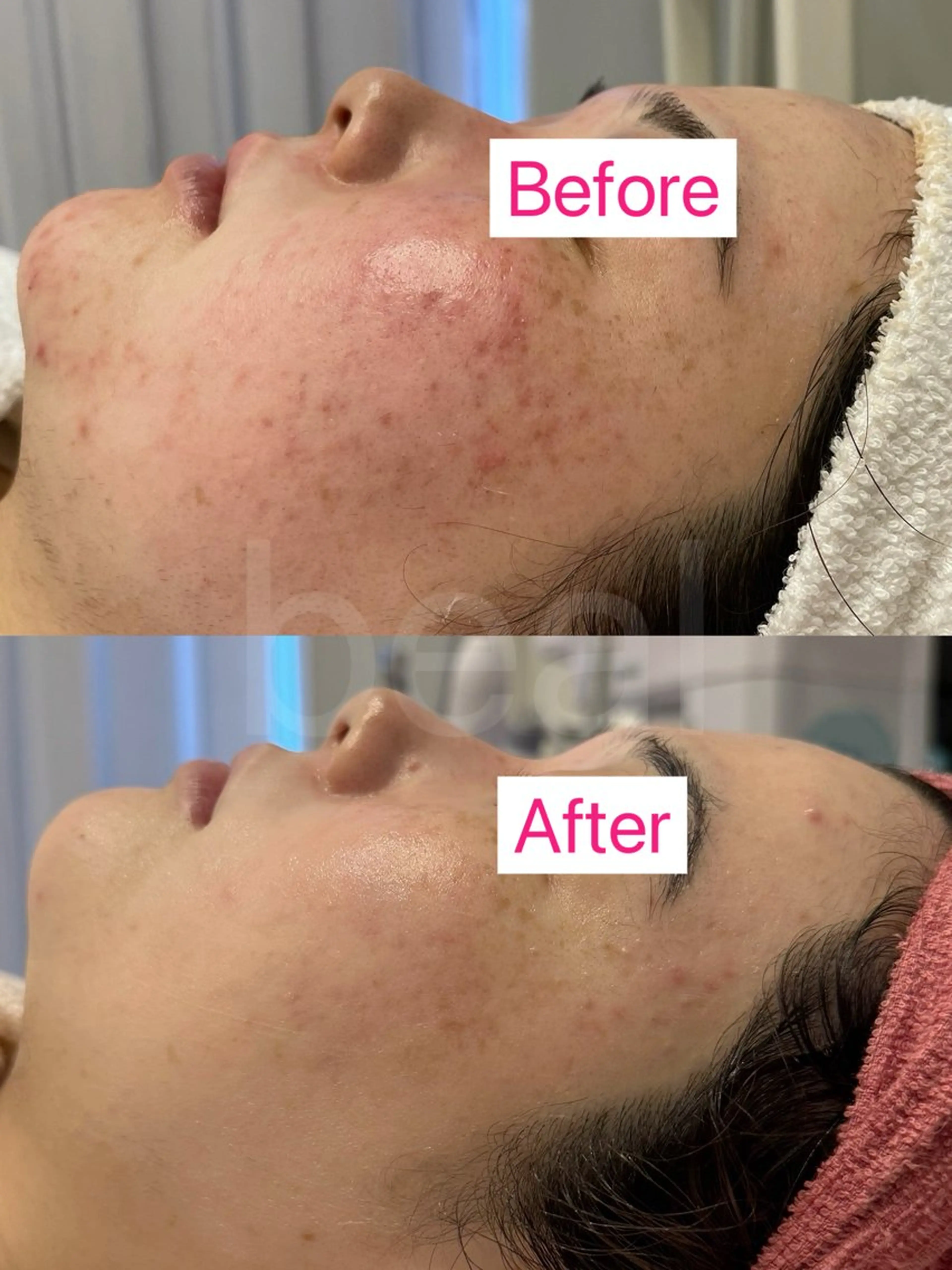 べアール所属・小顔/毛穴/ニキビ salon bealのエステ・リラクイメージ