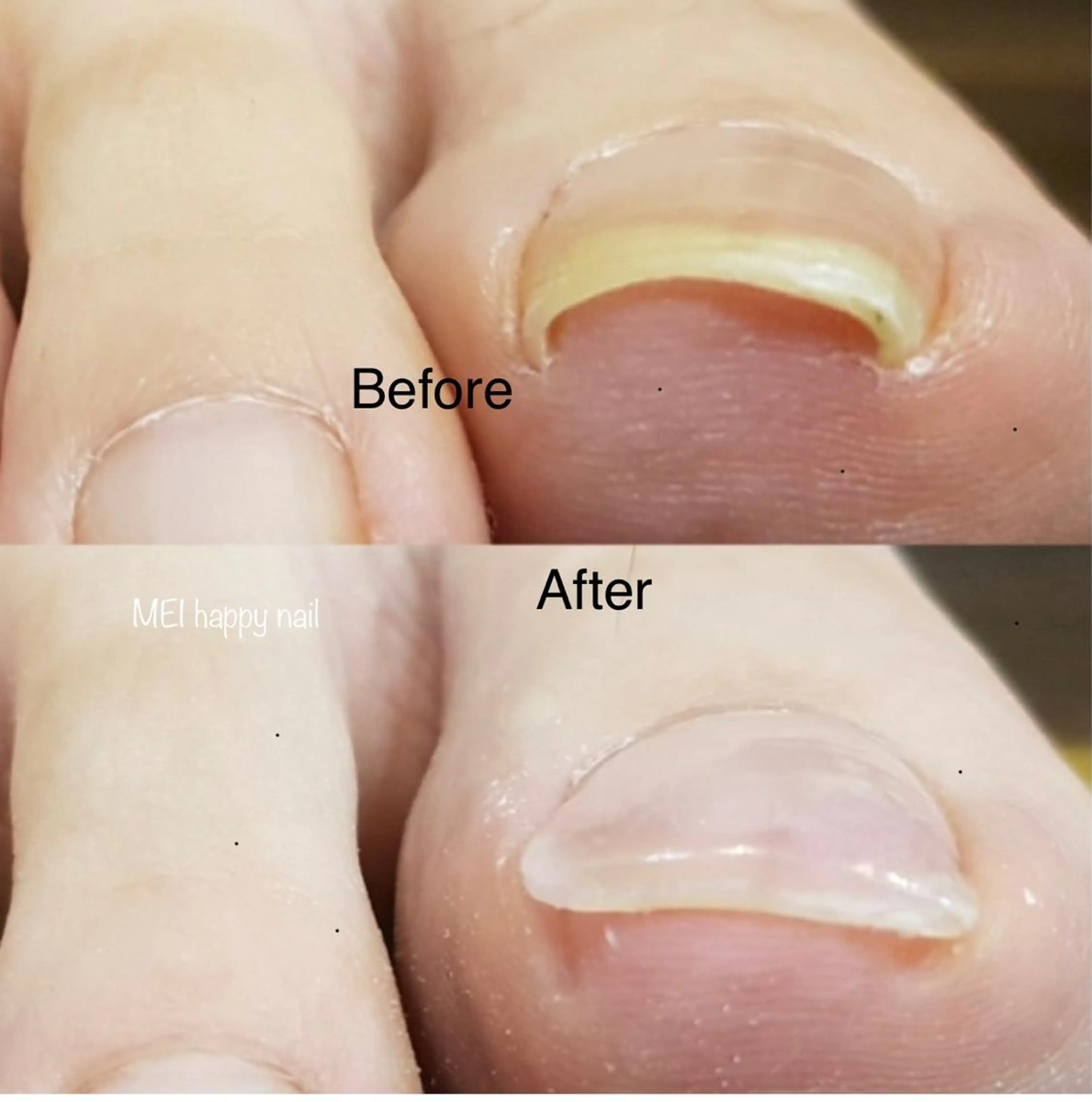 《フット巻き爪矯正》アクリル巻き爪矯正1本+ジェルワンカラー10本+フットバスに甘皮ケアの写真