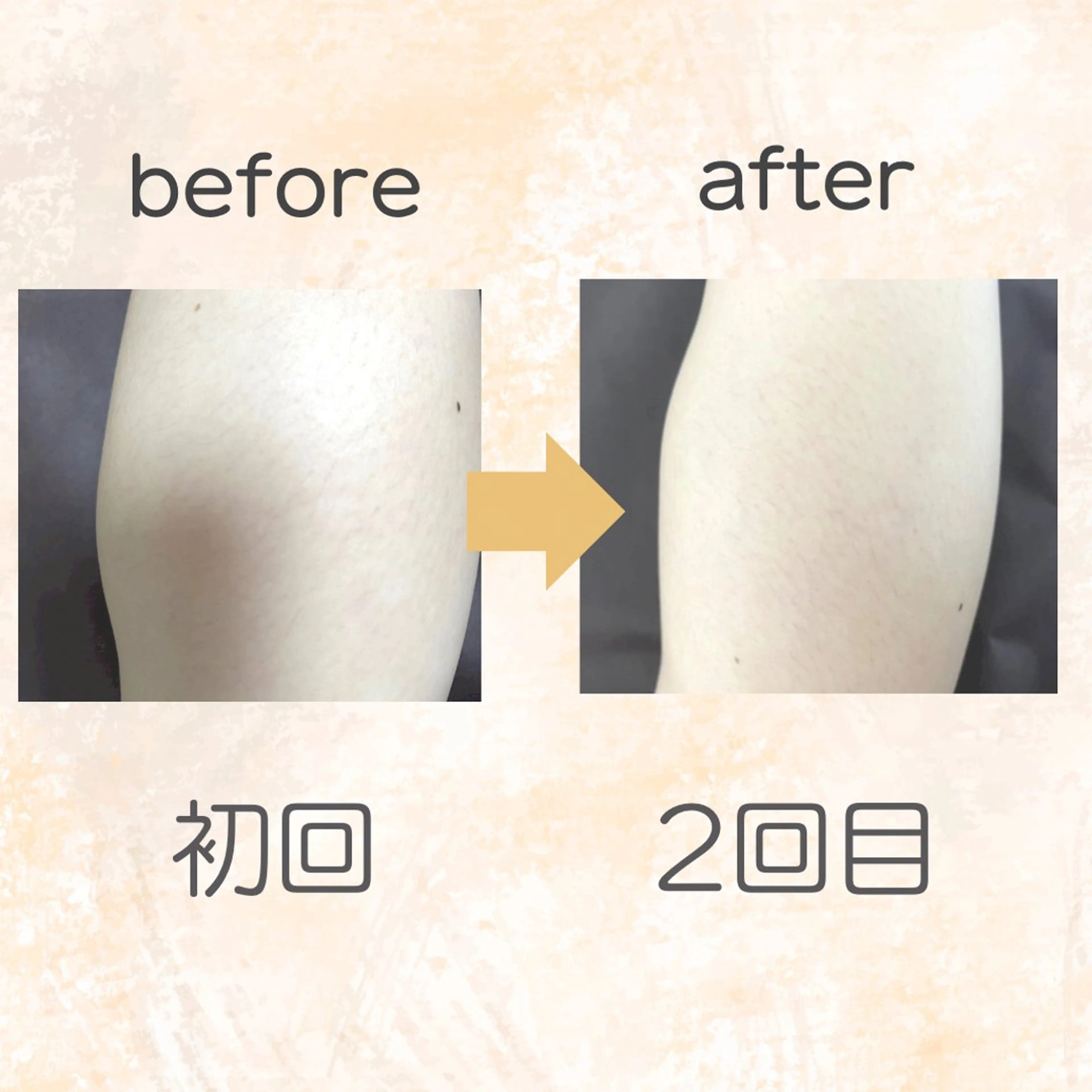 脱毛 脱毛専門店 Angemのエステ・リラクイメージ