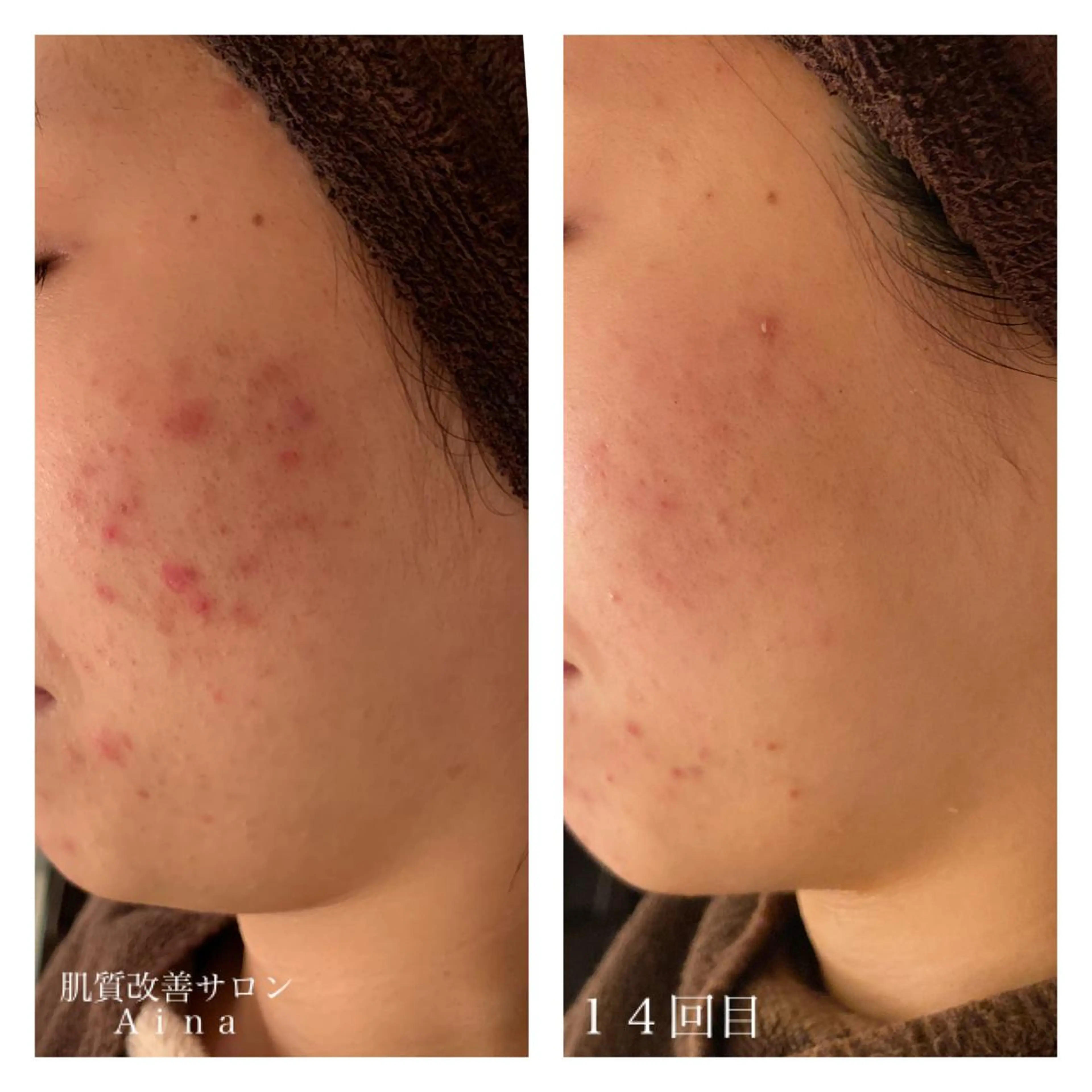 セミロング カラー パーマ ヘアアレンジ メンズ キッズ ネイル マツエク・マツパ 赤色 エステ リラク ニキビ跡専門サロン Ａｉｎａのエステ・リラクイメージ