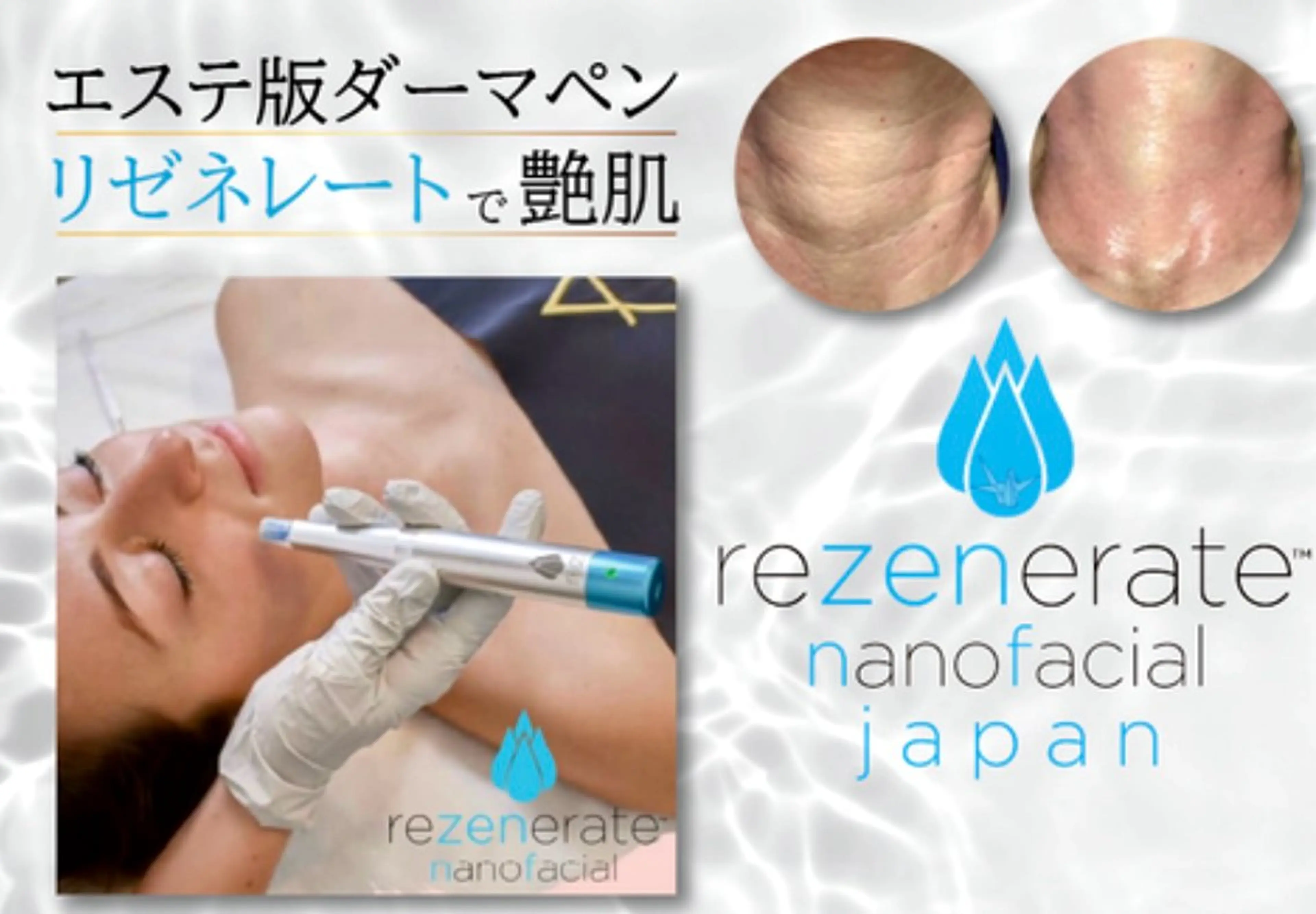 【毛穴・クレーター・引き締め・透明感◎】クリニック人気施術エステ版ダーマエステ60分の写真