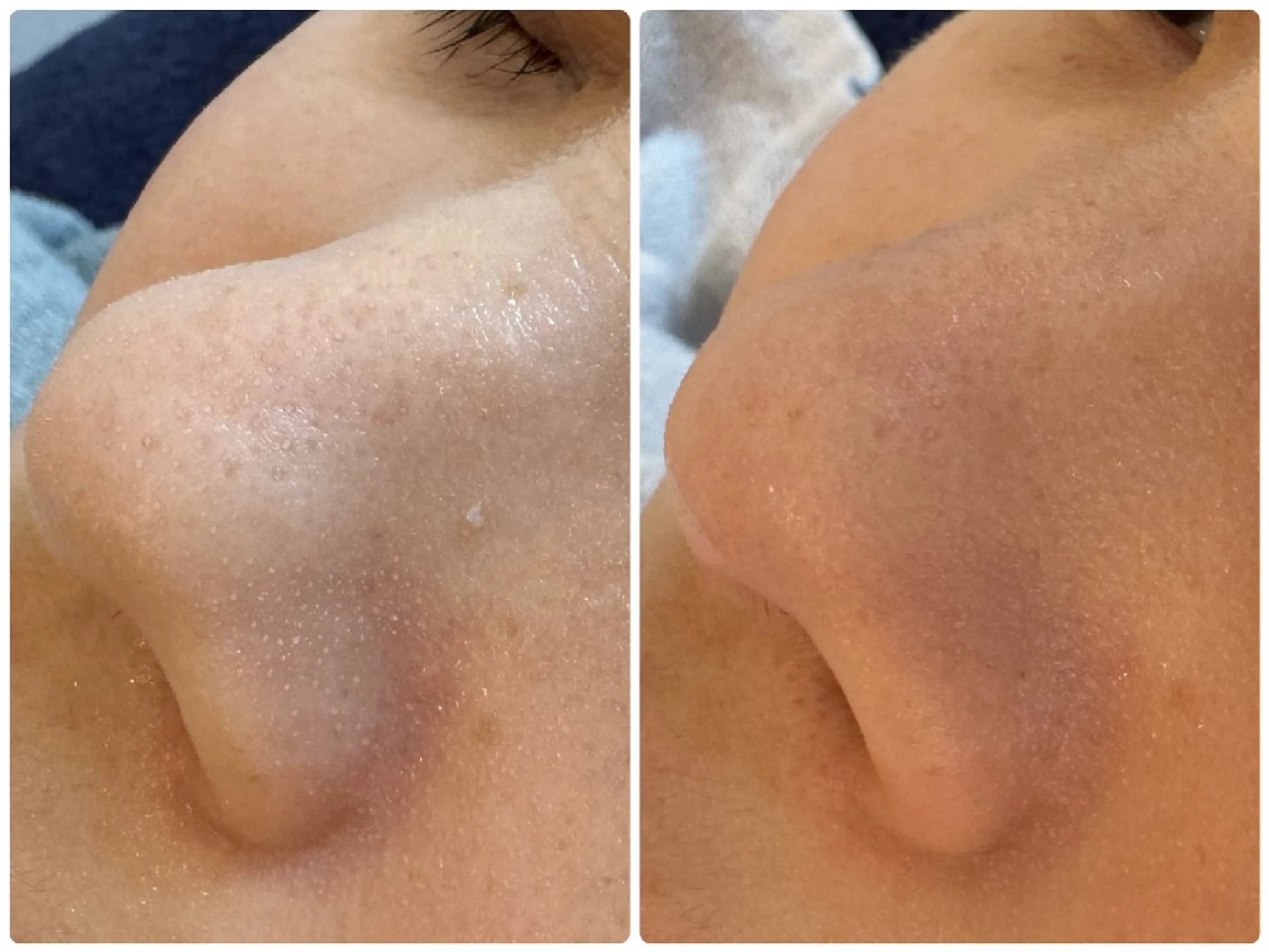 いちご鼻、くすみ毛穴改善！毛穴洗浄フェイシャルの写真