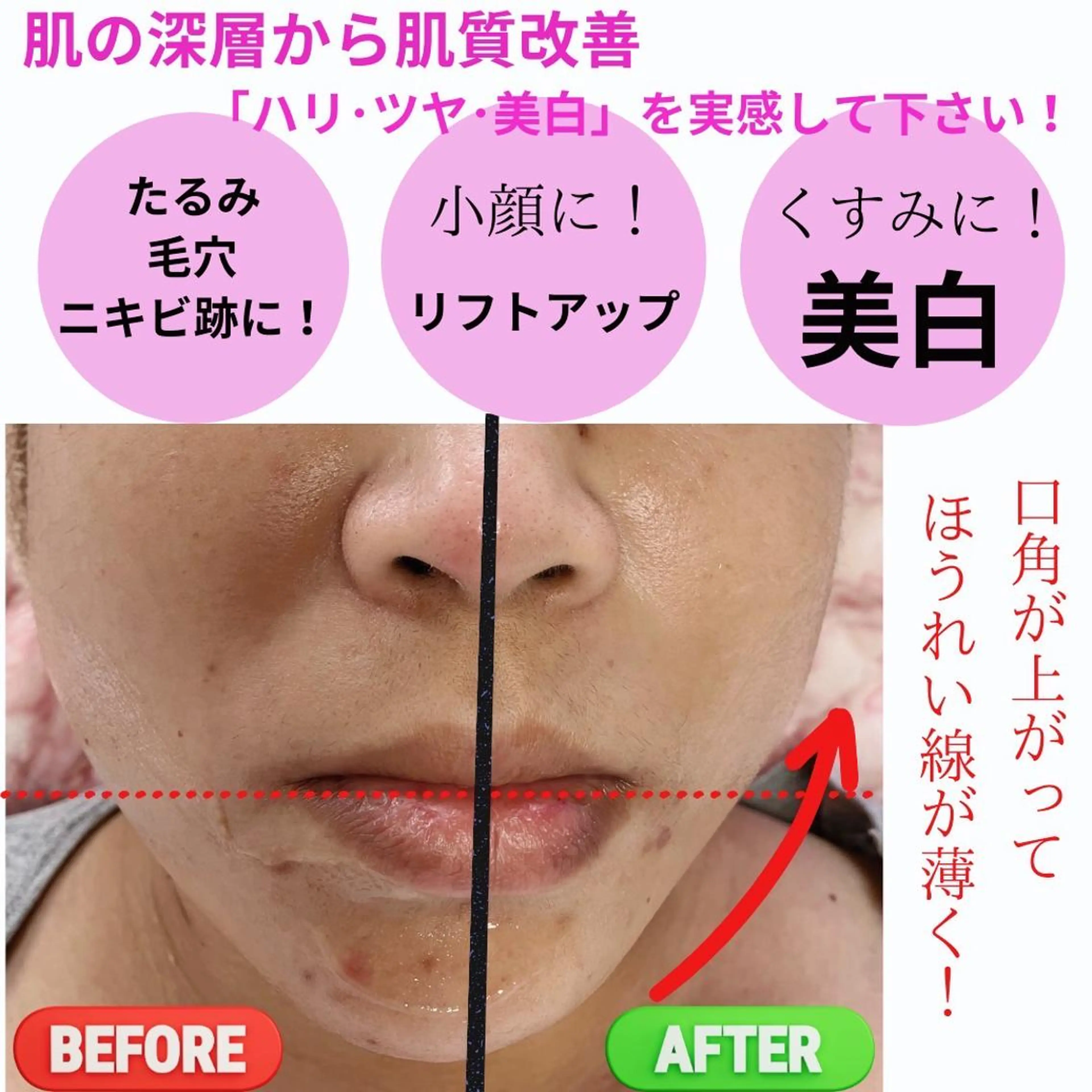 【美肌へ】★美白★シワ改善★！痛みなし小顔矯正➕光フォト（悩み別マスクつき)ウルツル肌へ！リフトアップ！の写真