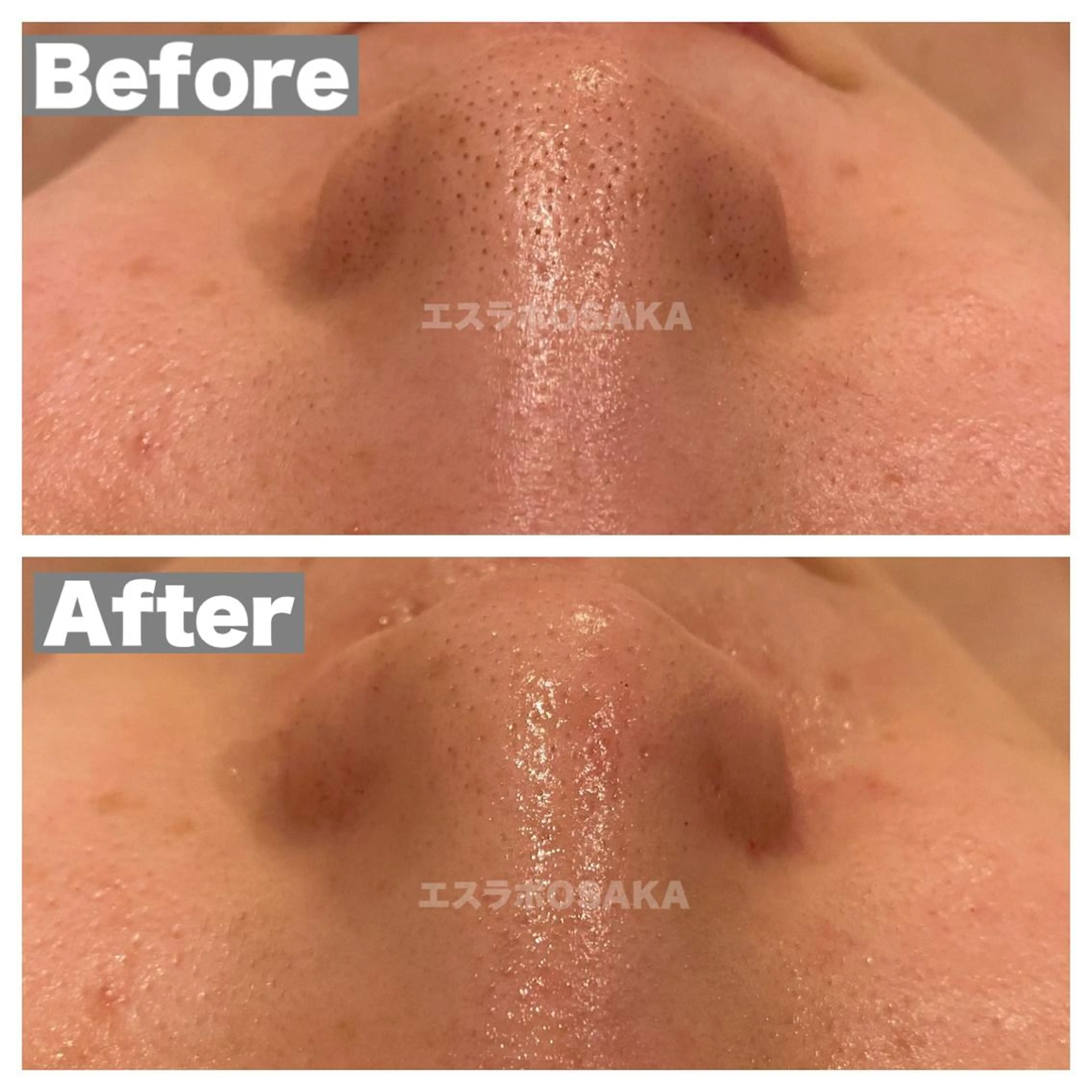 【高濃度水素毛穴洗浄】✖︎【ピーリング洗浄】の写真