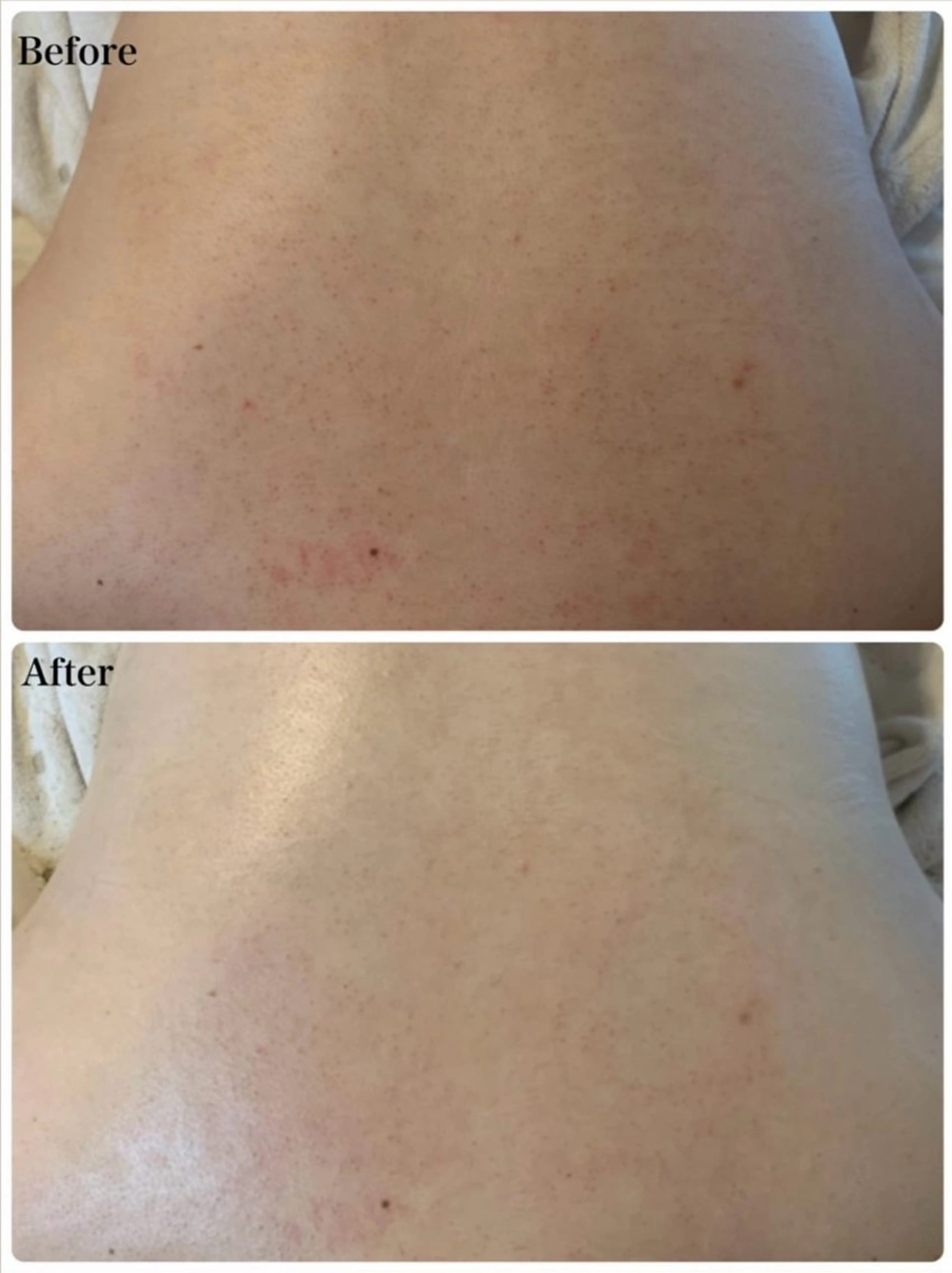 【 背中全体ケア 】 REVIハーブピーリング🌿の写真