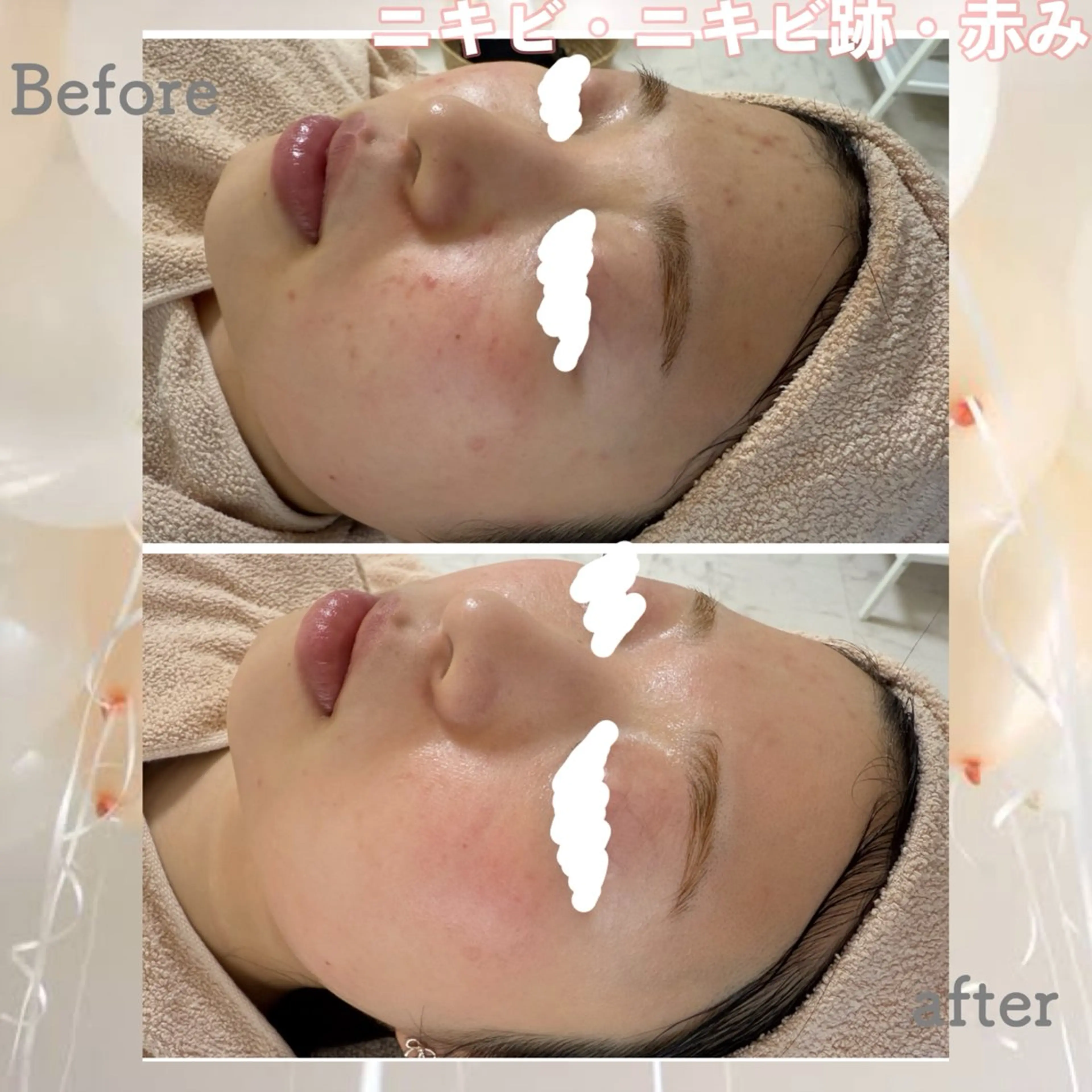 エステ ニキビ&跡改善サロン オーナー光木のエステ・リラクイメージ