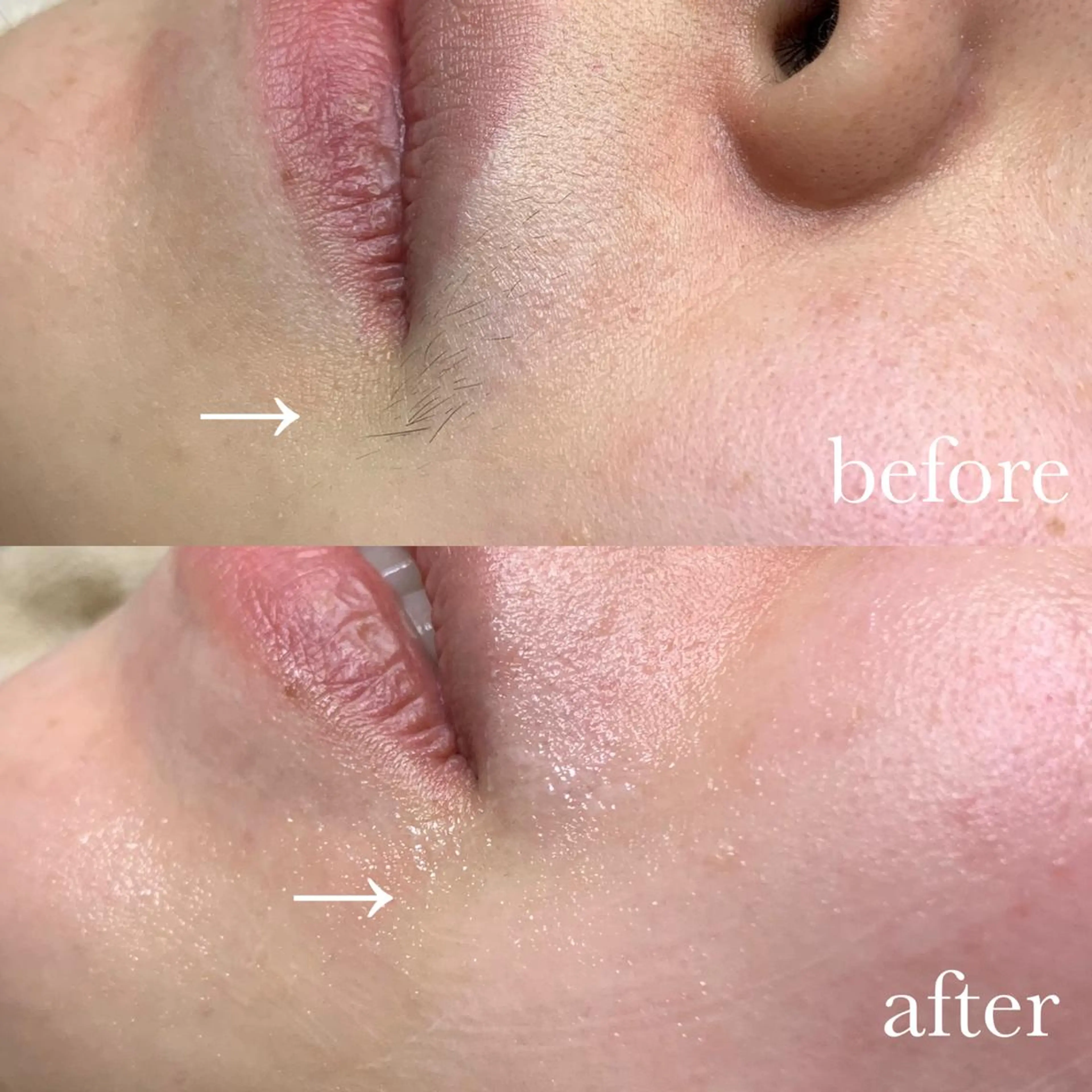 フェイシャルワックス脱毛の写真